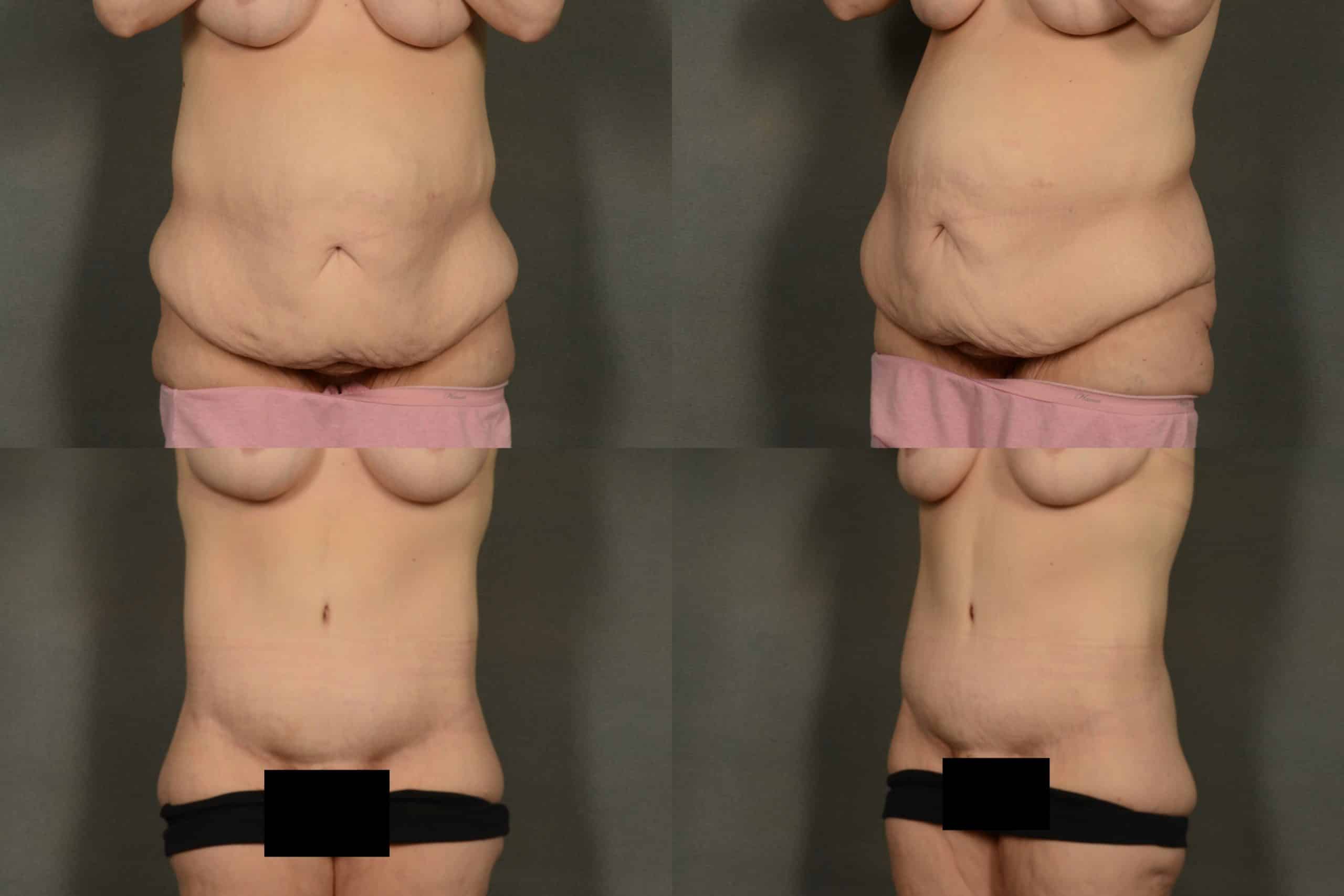 Tummy Tuck Case#965 Combined Image