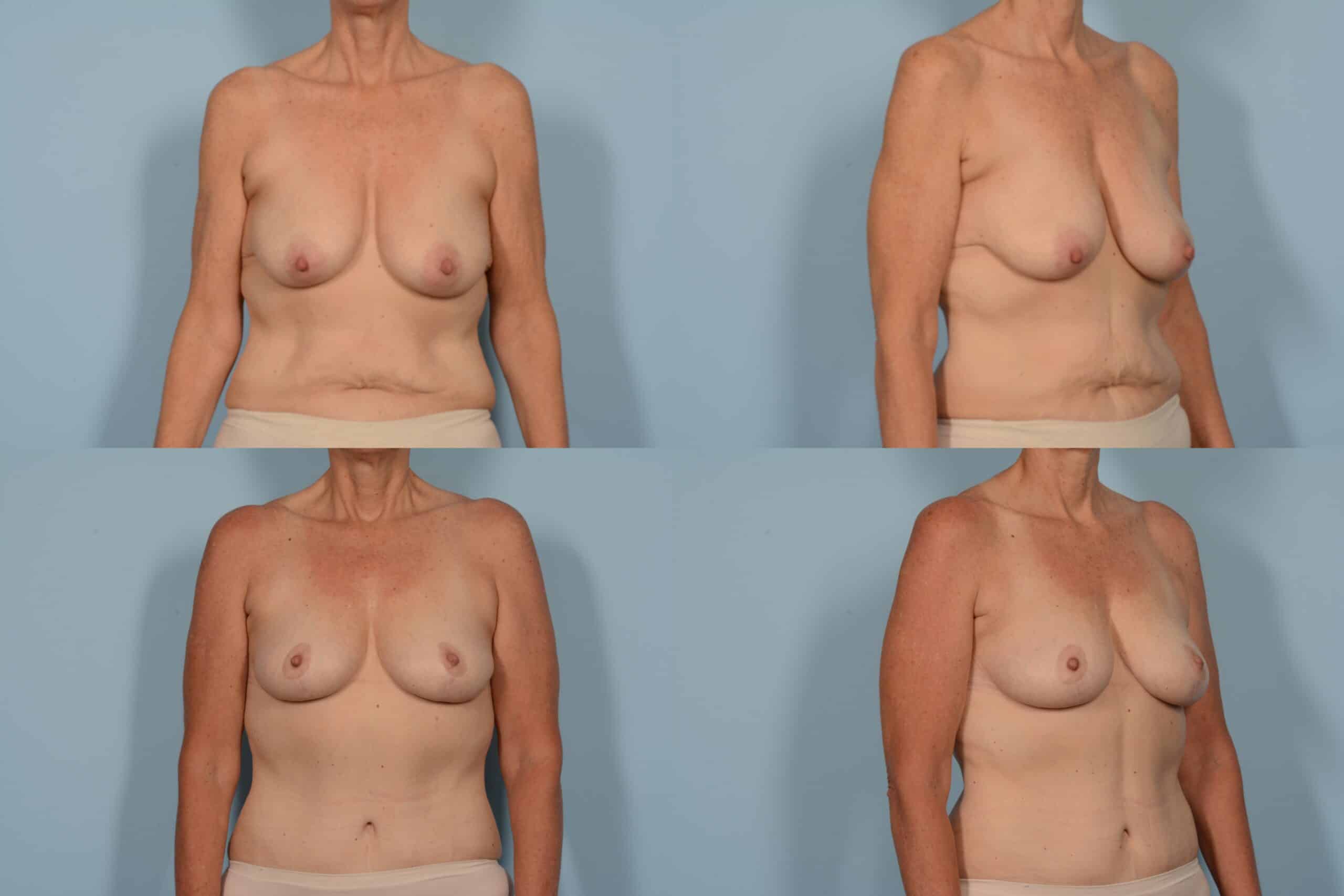 Breast Lift Case# 1150 Combined Image