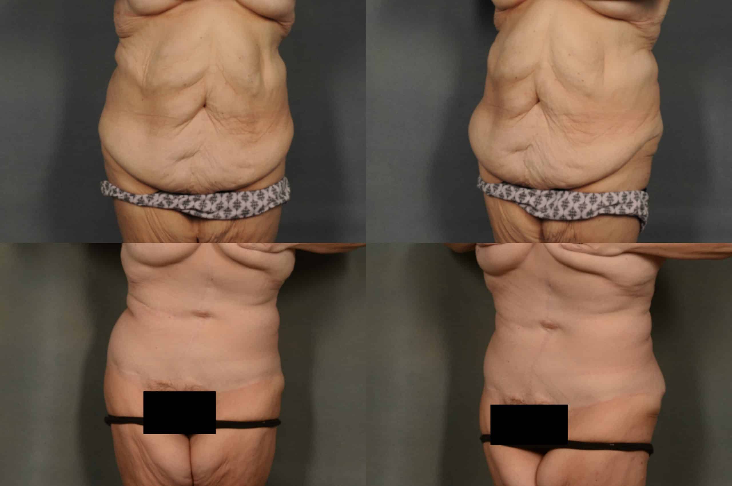 Tummy Tuck Case# 970 Combined Image