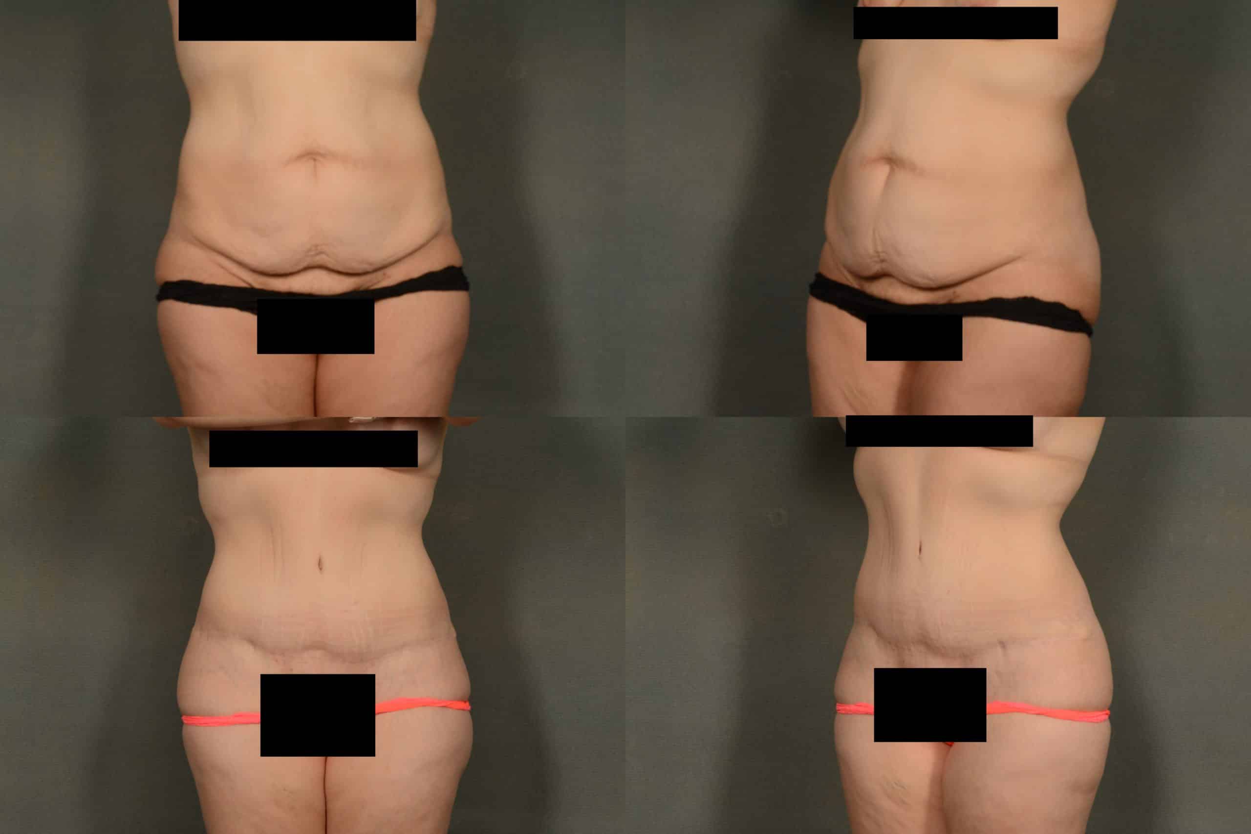 Tummy Tuck Case# 987 Combined Image