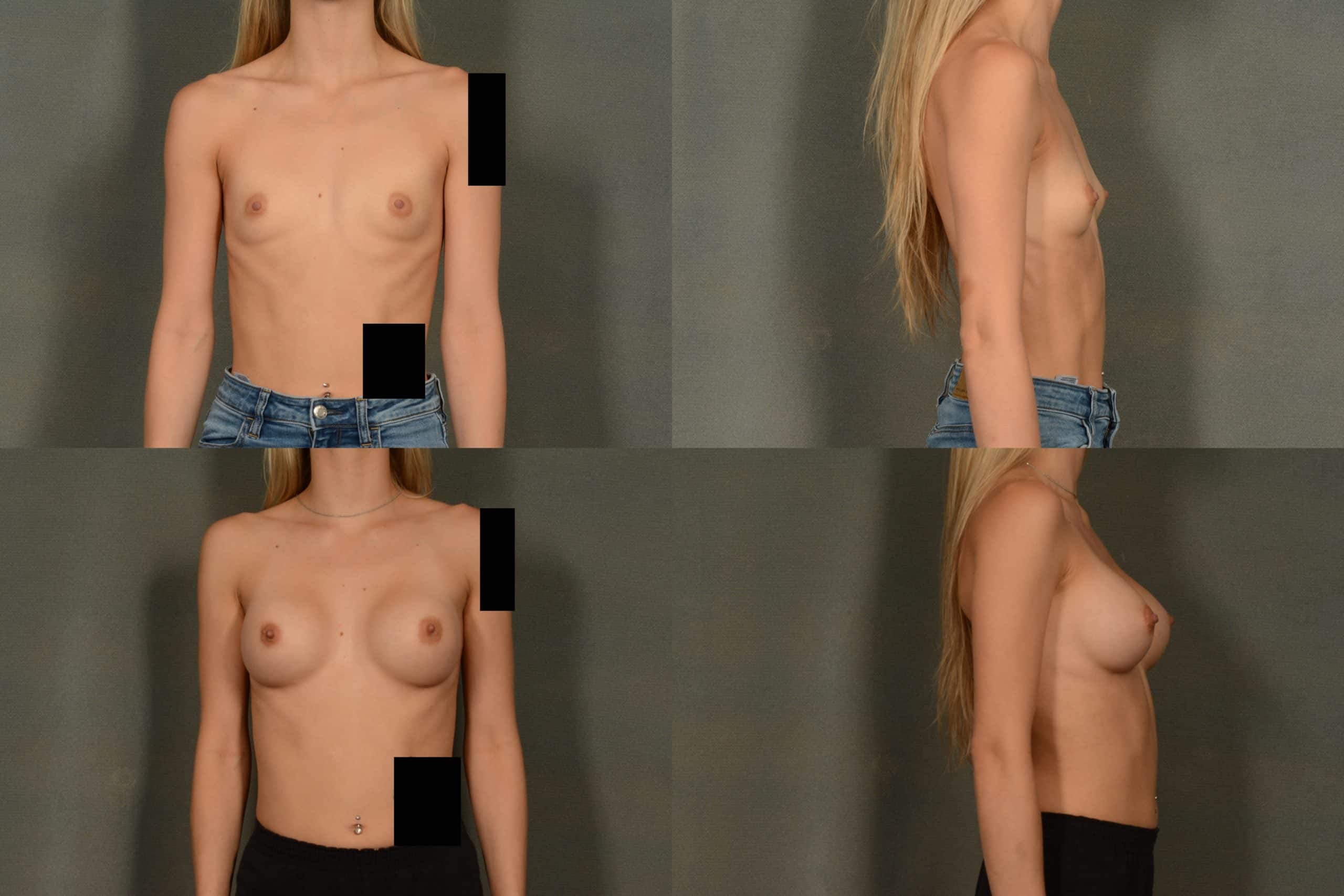 Breast Augmentation Case# 1033 Combined Image