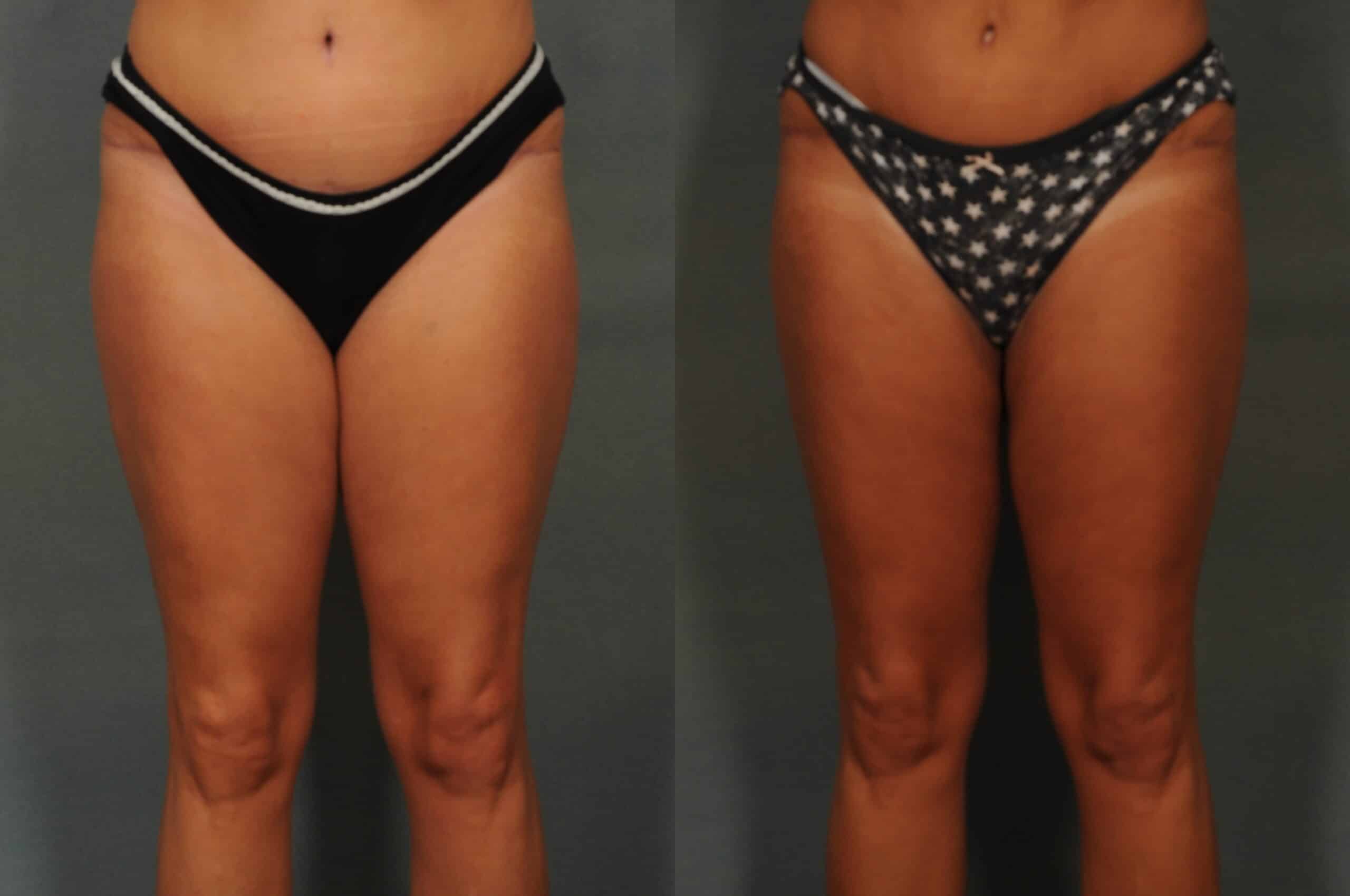 Liposuction Case# 1071 Combined Image
