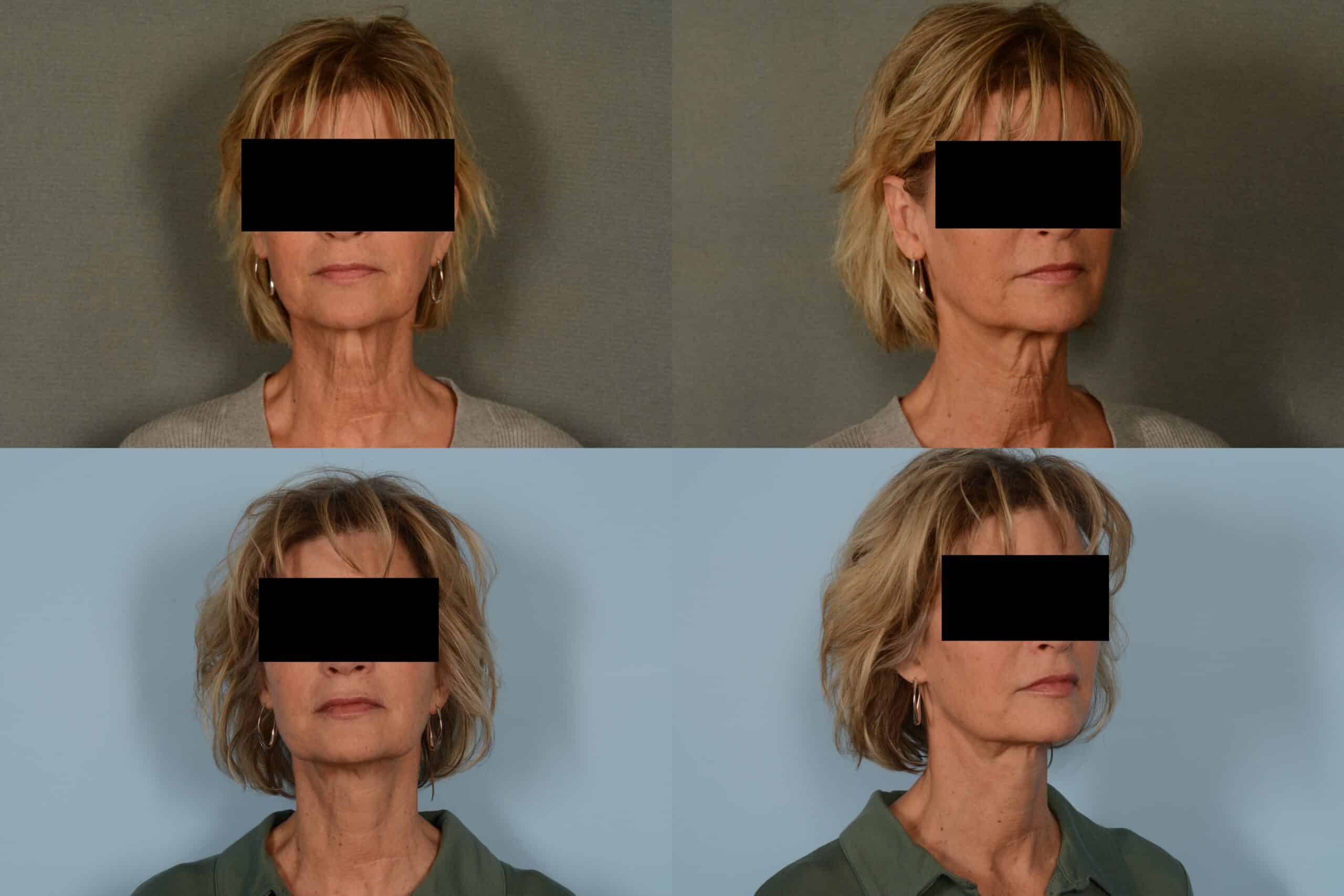Neck Lift Case# 1085 Combined Image