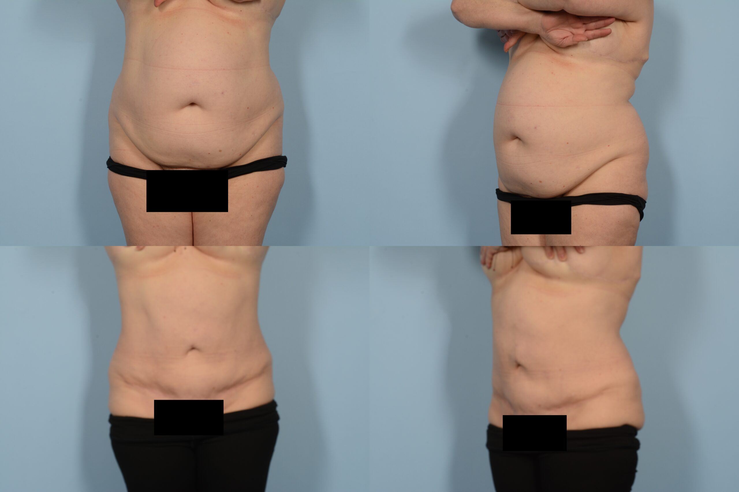 Liposuction Case# 1150 Combined Image