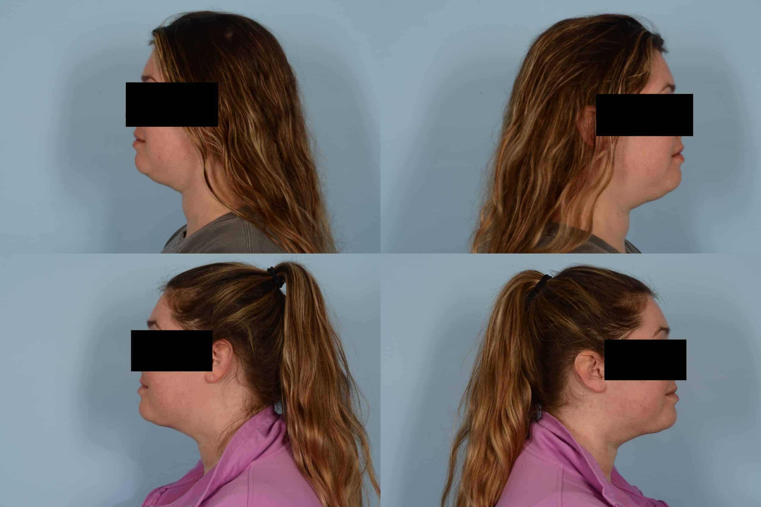 Liposuction Case# 1117 Combined Image