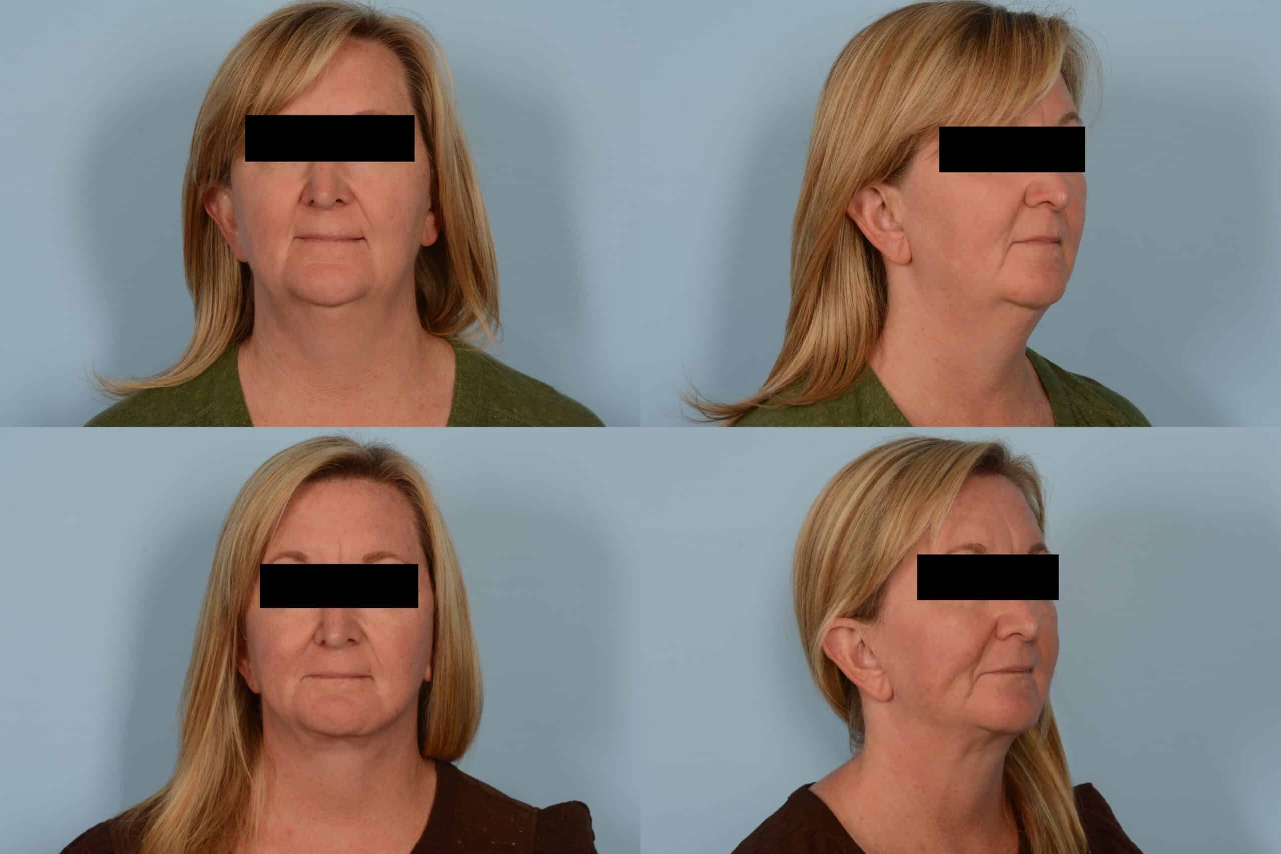 Face Lift Case # 1129 Combined Image