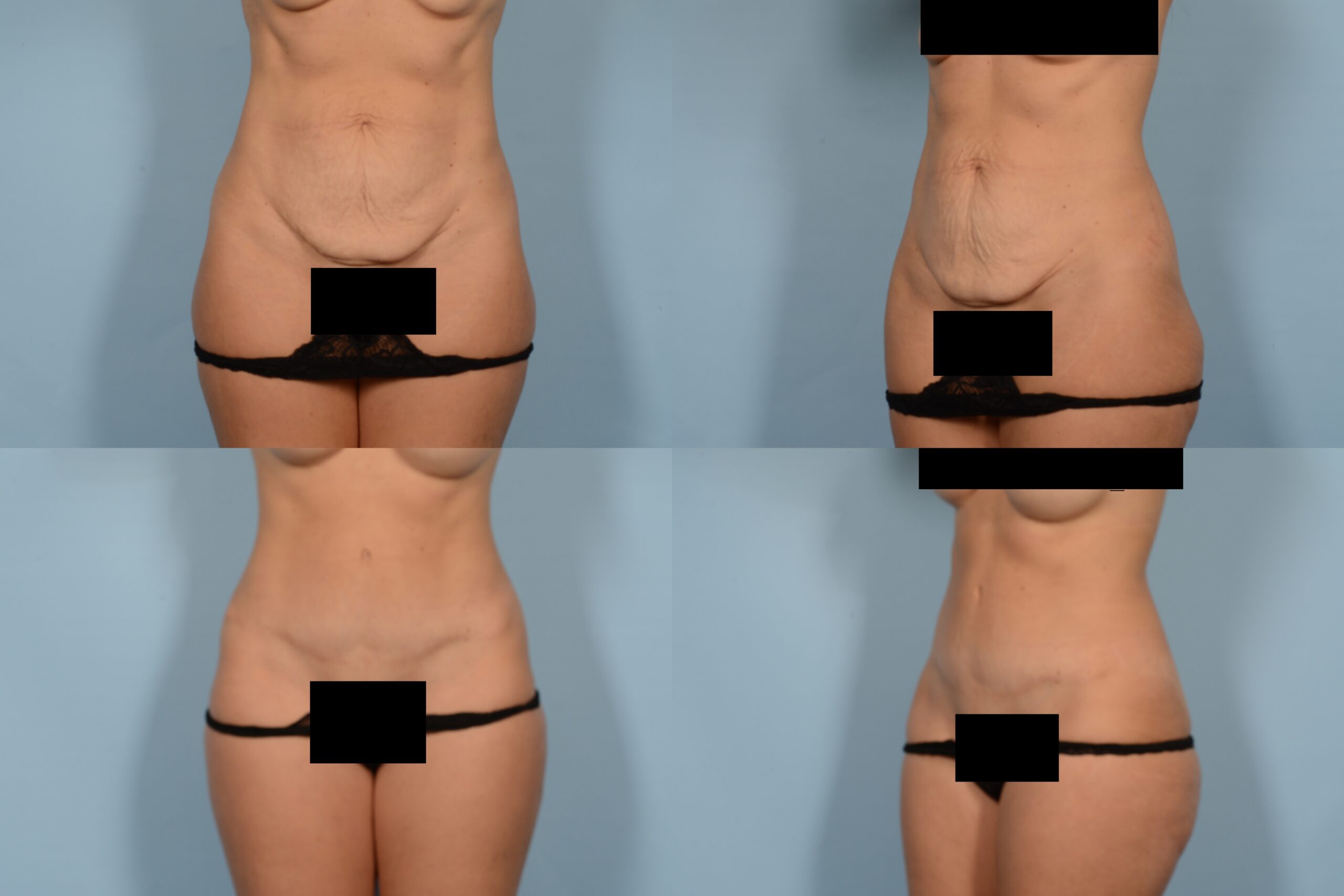 Tummy Tuck Case# 1104 Combined Image