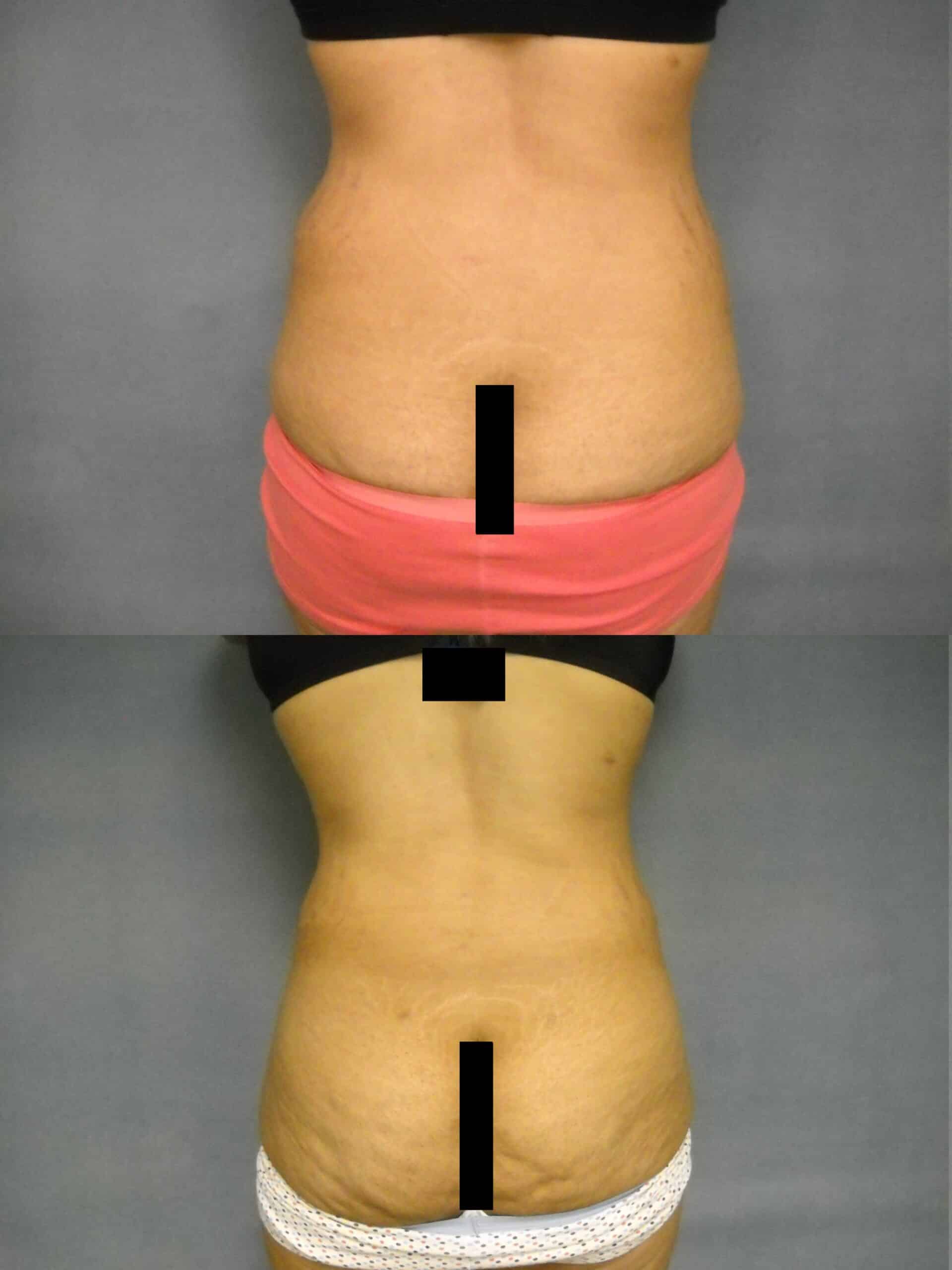 Liposuction Case# 1077 Combined Image
