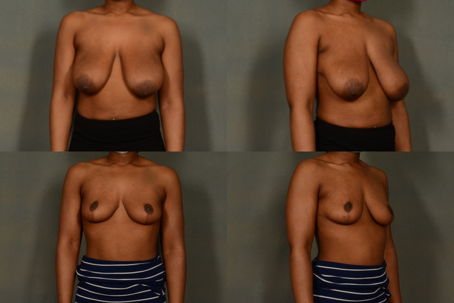 Breast Lift Case# 1034 Combined Image