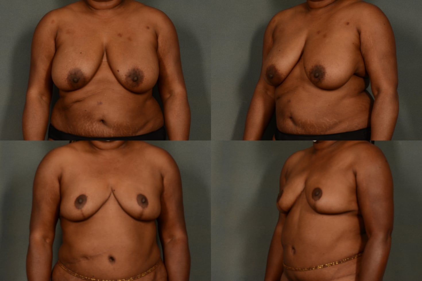 Breast Reduction Case# 959 Combined Image