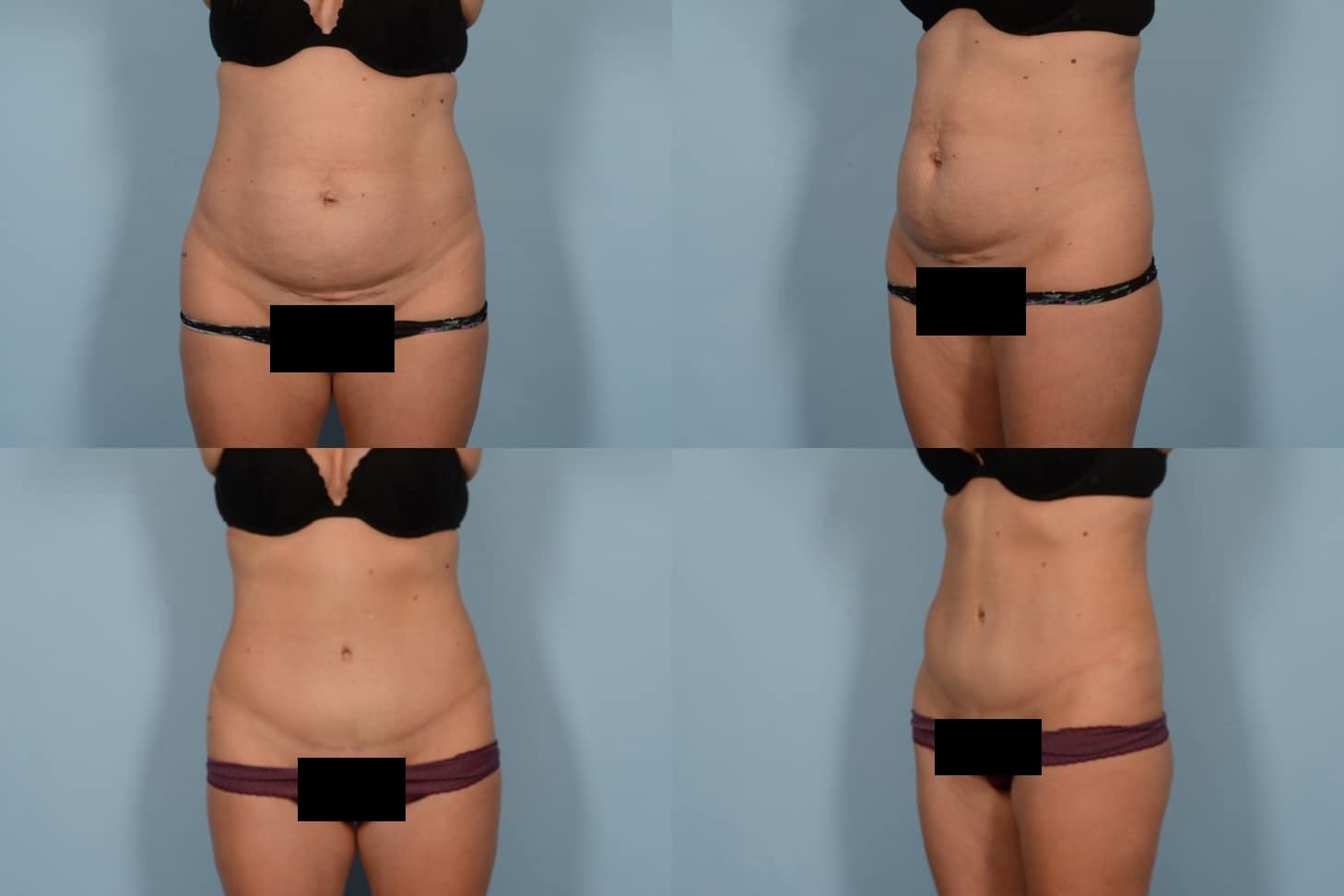 Tummy Tuck Case# 1118 Combined Image