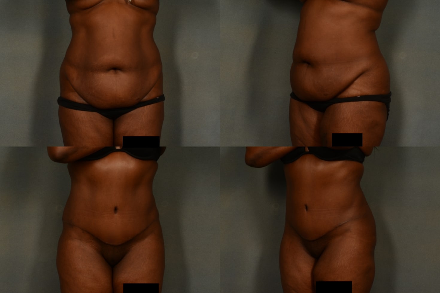 Tummy Tuck Case# 1018 Combined Image