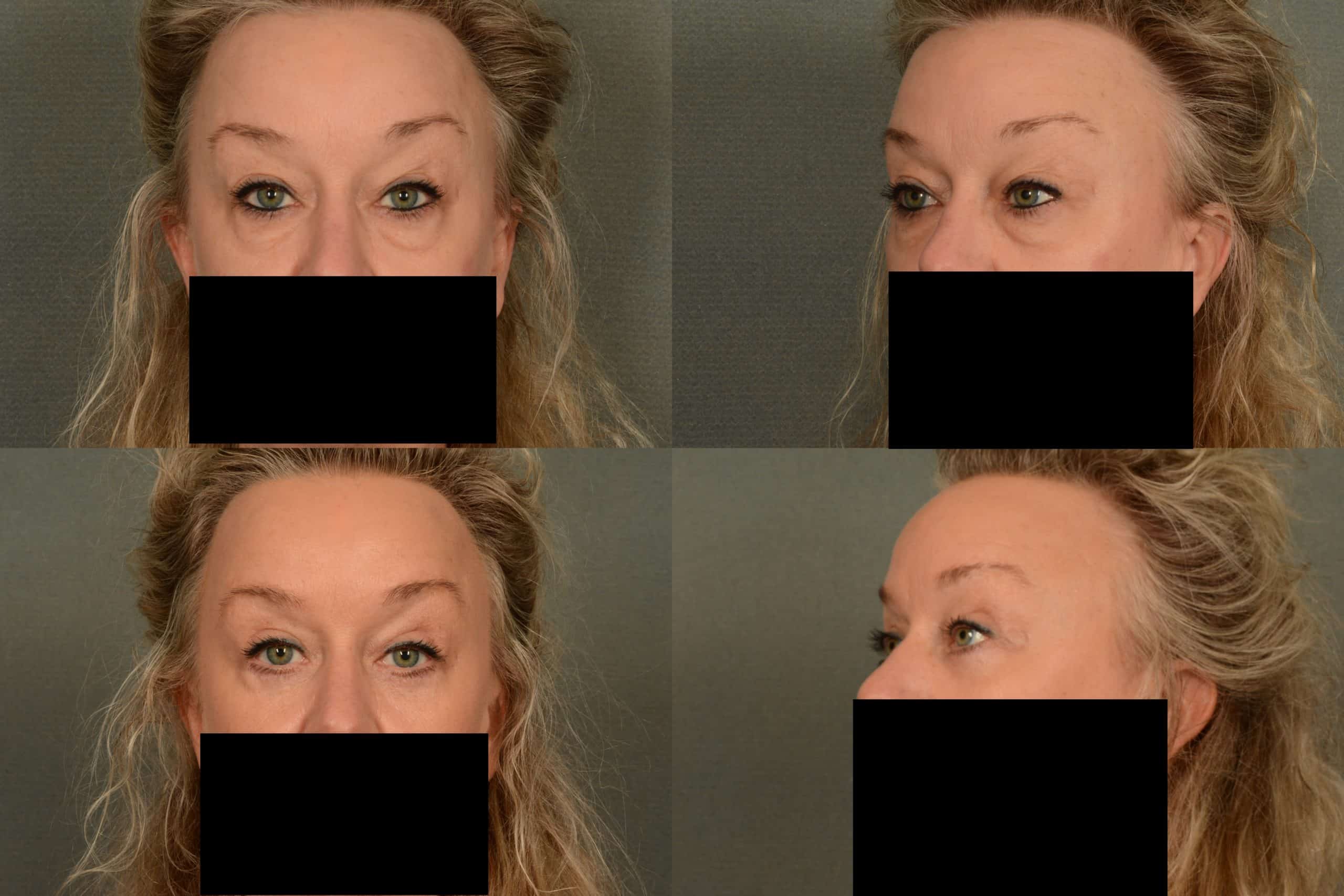 Blepharoplasty Case# 1035 Combined Image