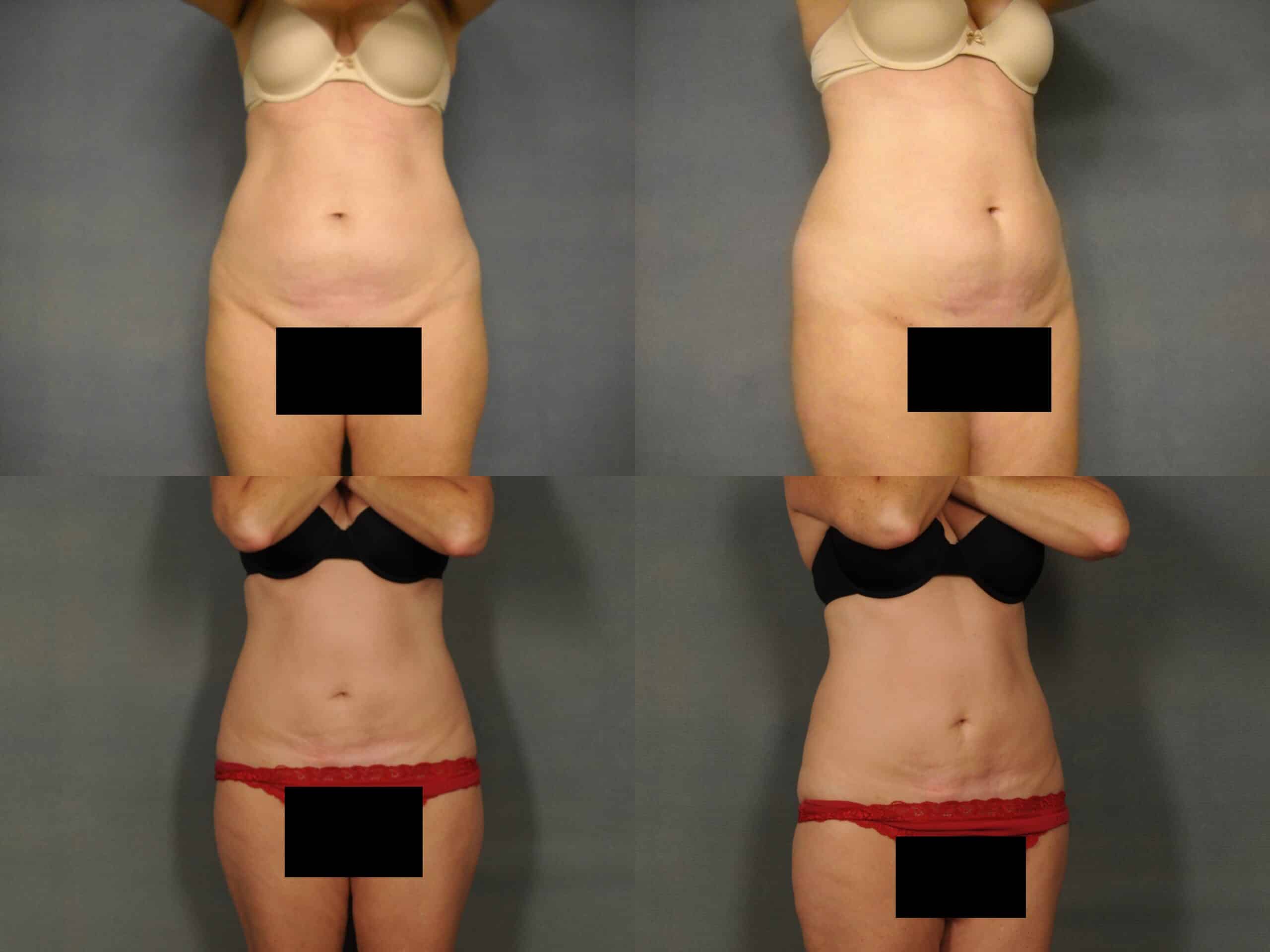 Liposuction Case# 1075 Combined Image