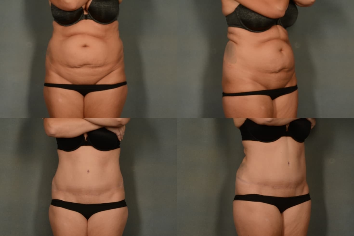 Tummy Tuck Case #973 Combined Image