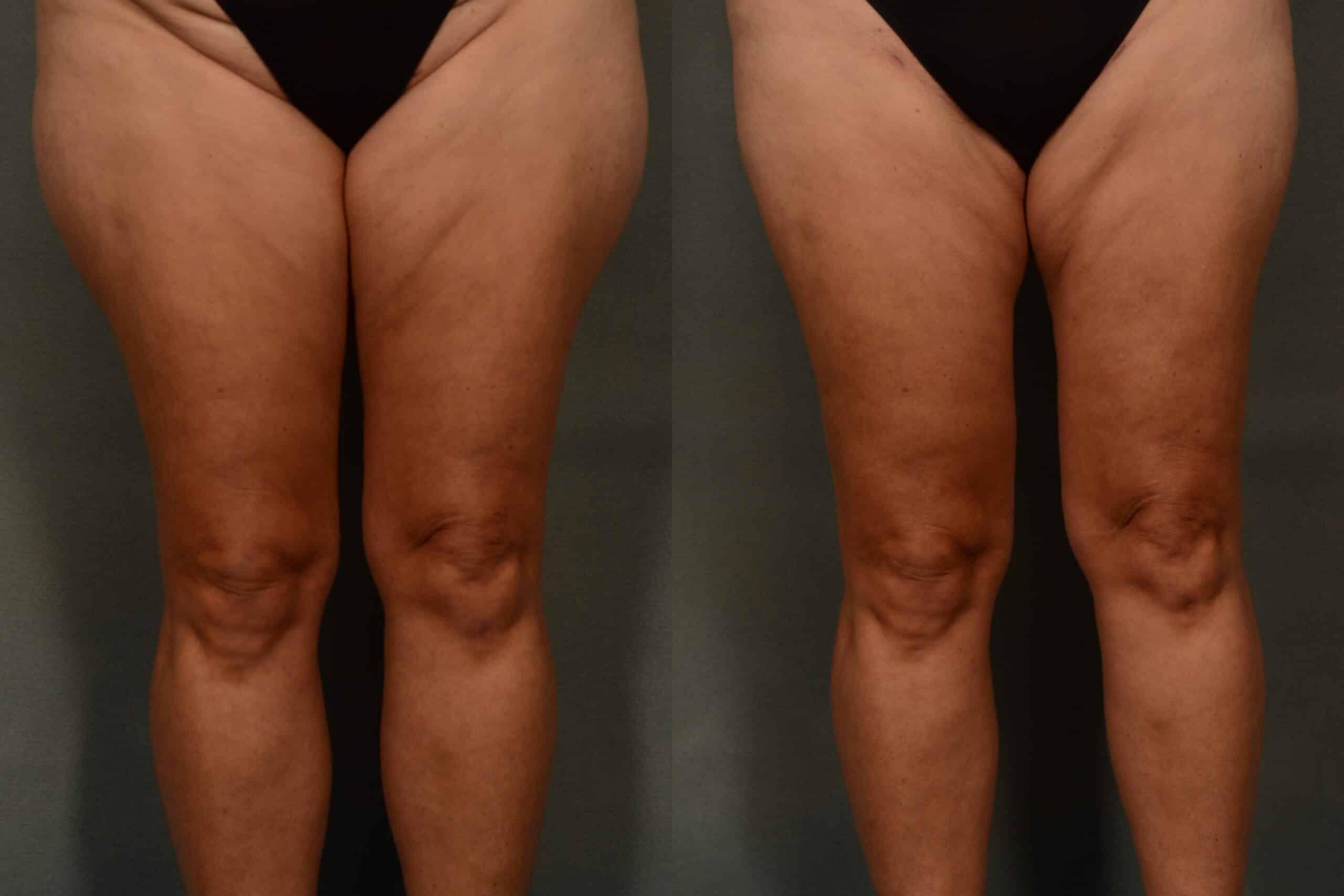 Liposuction Case# 1078 Combined Image