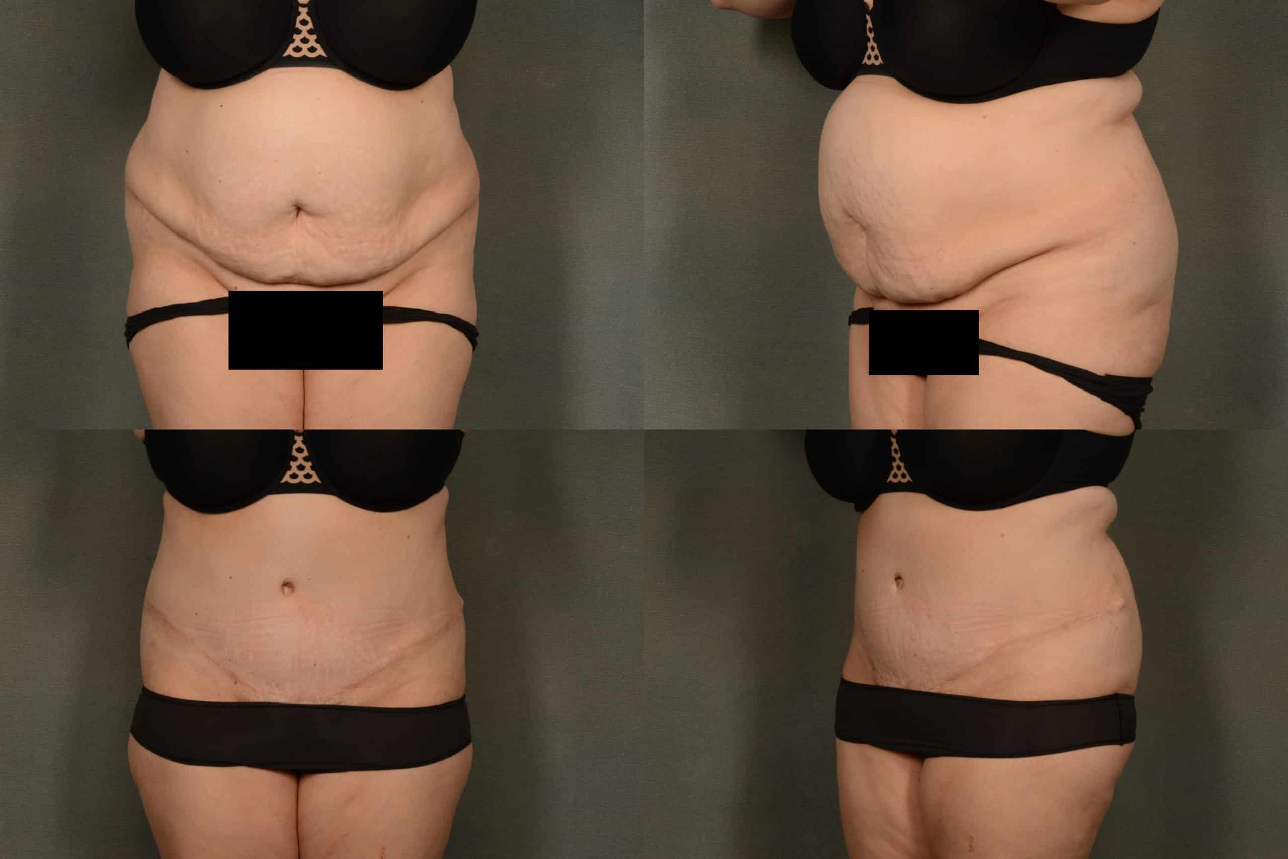 Tummy tuck Case# 1036 Combined Image