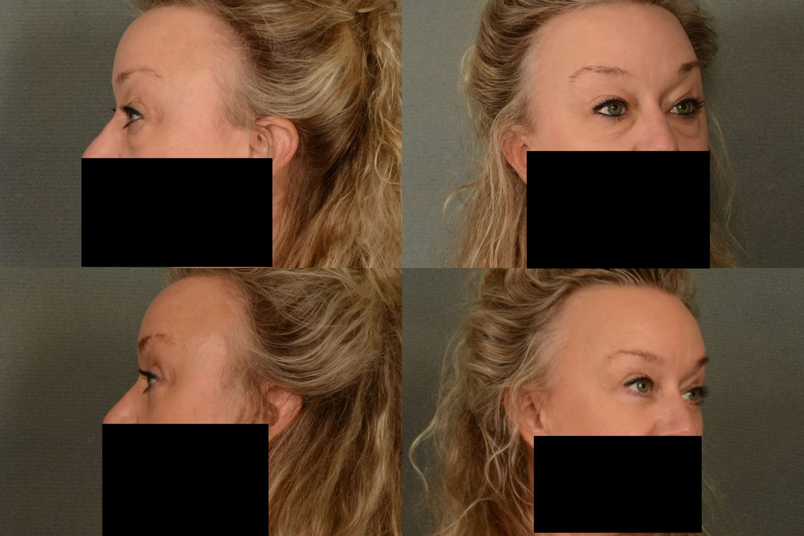 Blepharoplasty Case# 1035 Combined Image