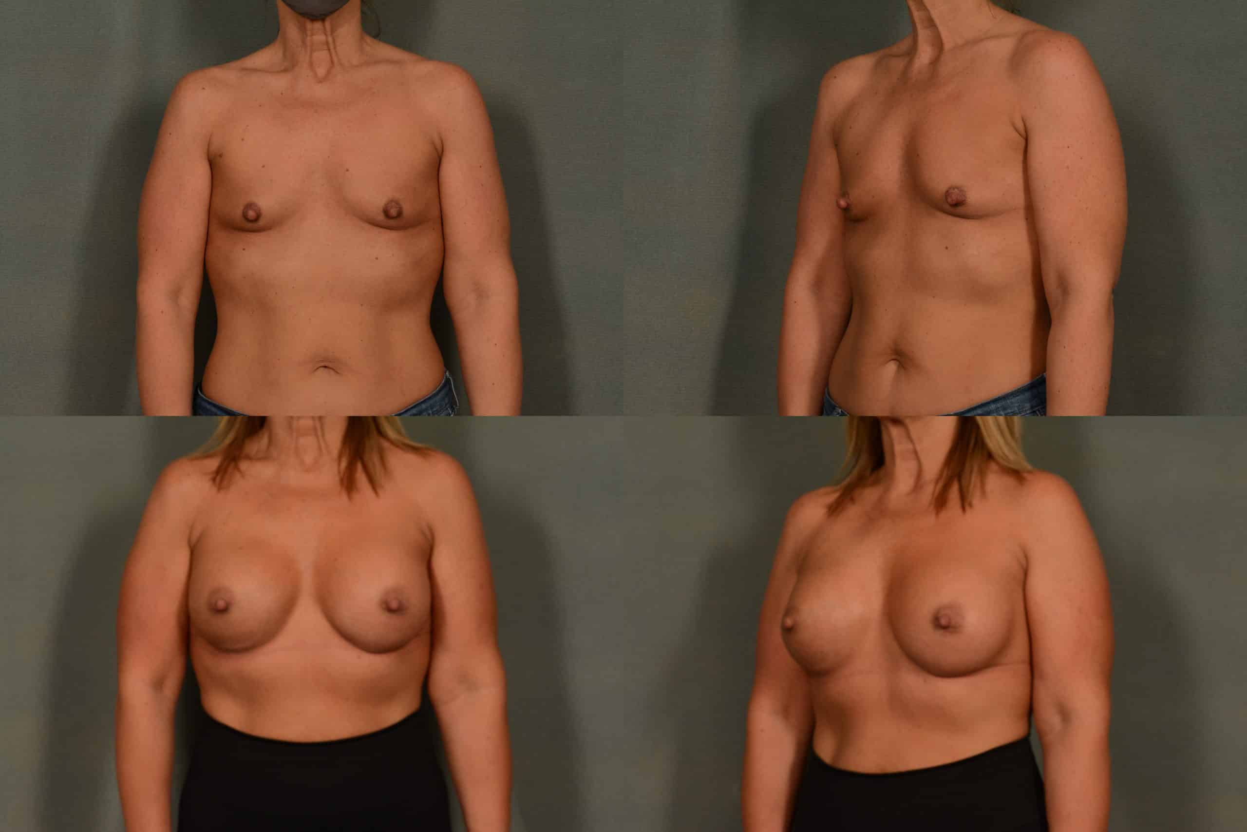 Breast Augmentation Case# 1022 Combined Image