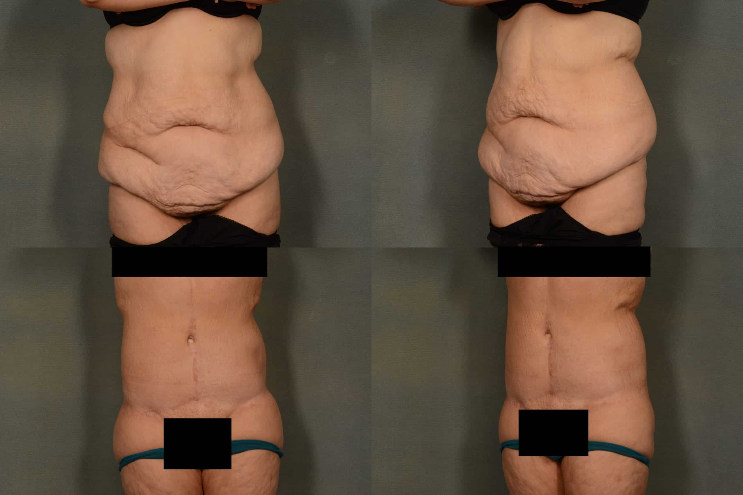 Tummy Tuck Case# 1003 Combined Image