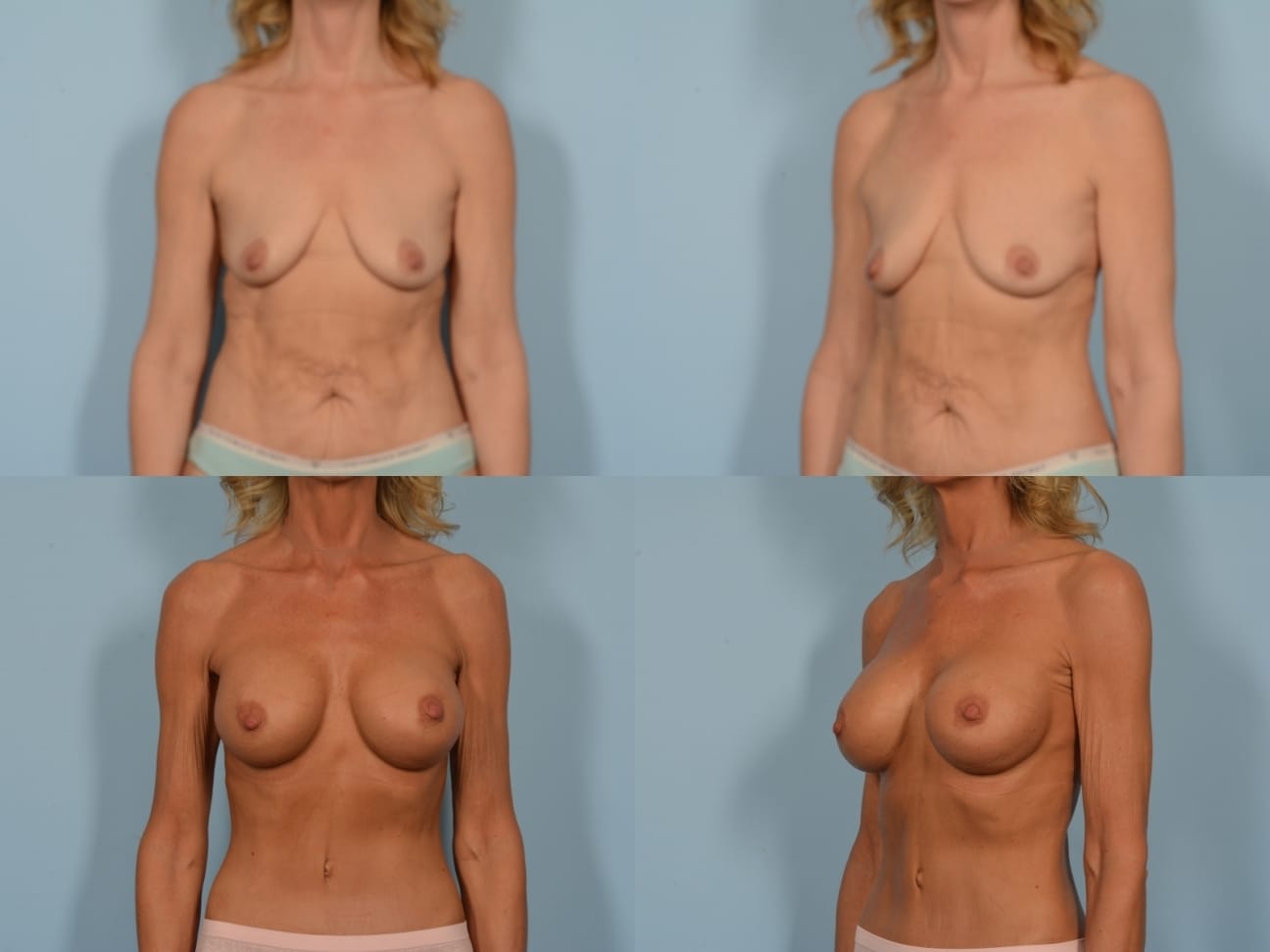 Breast Augmentation Case# 1201 Combined Image