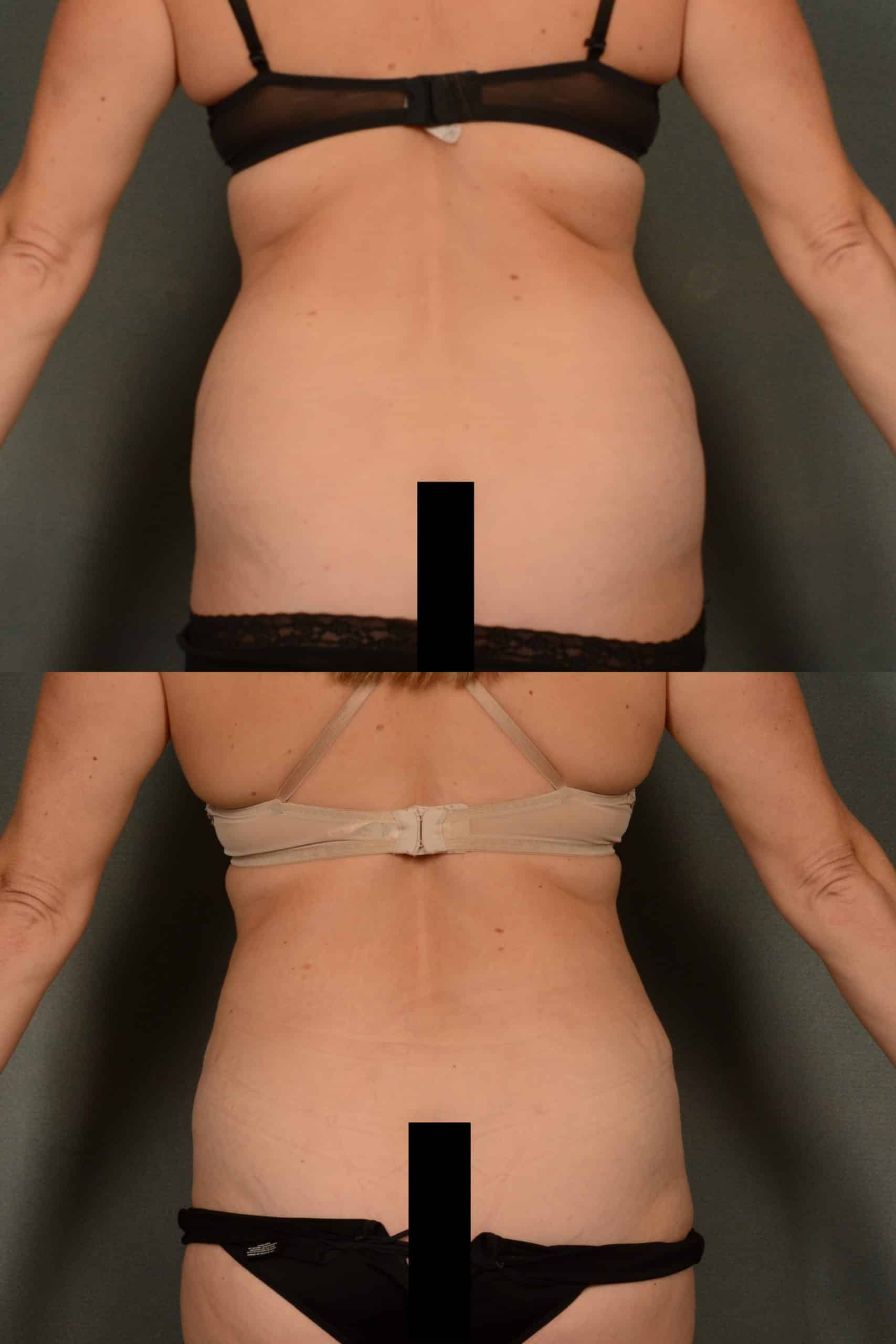 Liposuction Case# 971 Combined Image