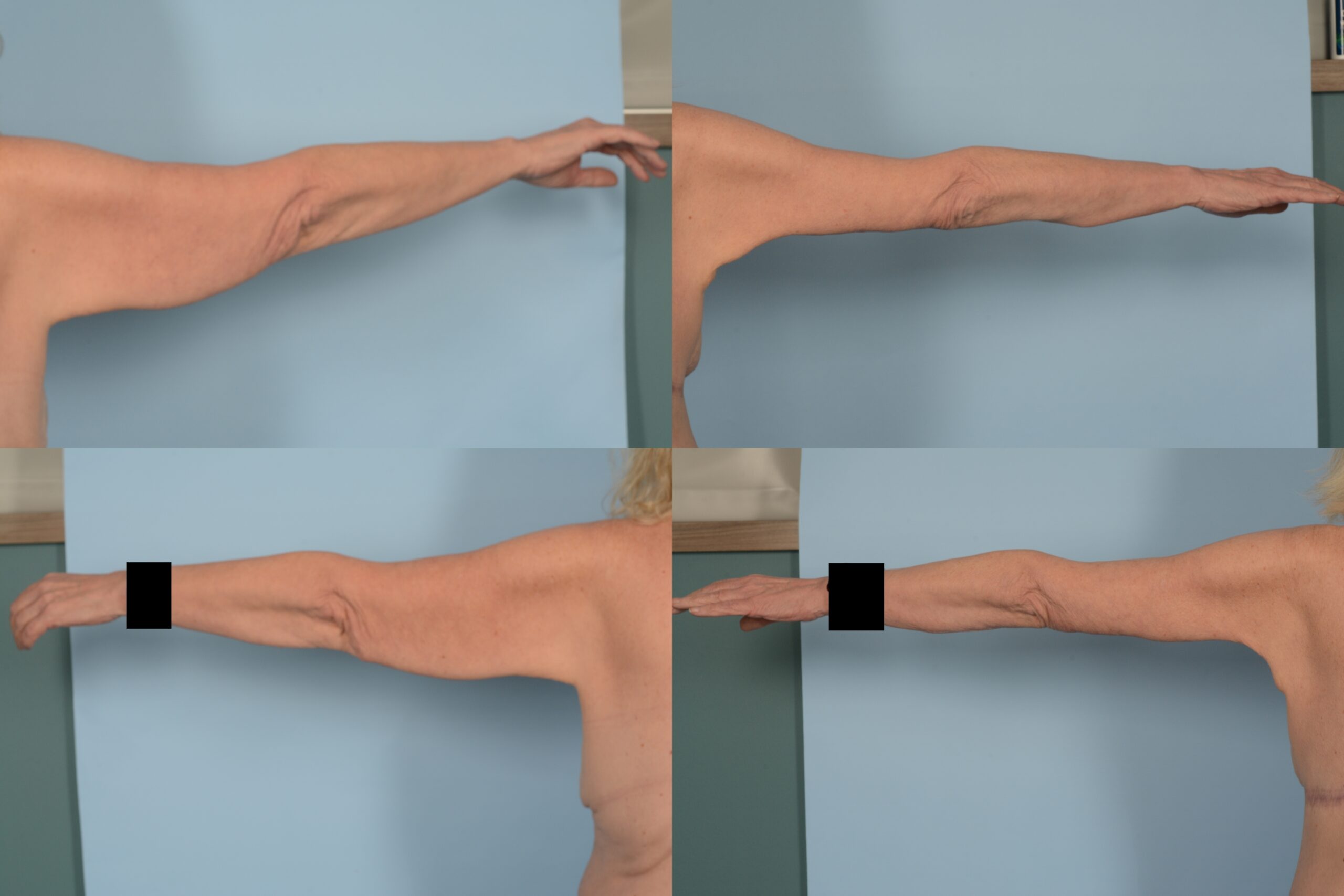 Arm Lift Case# 1112 Combined Image