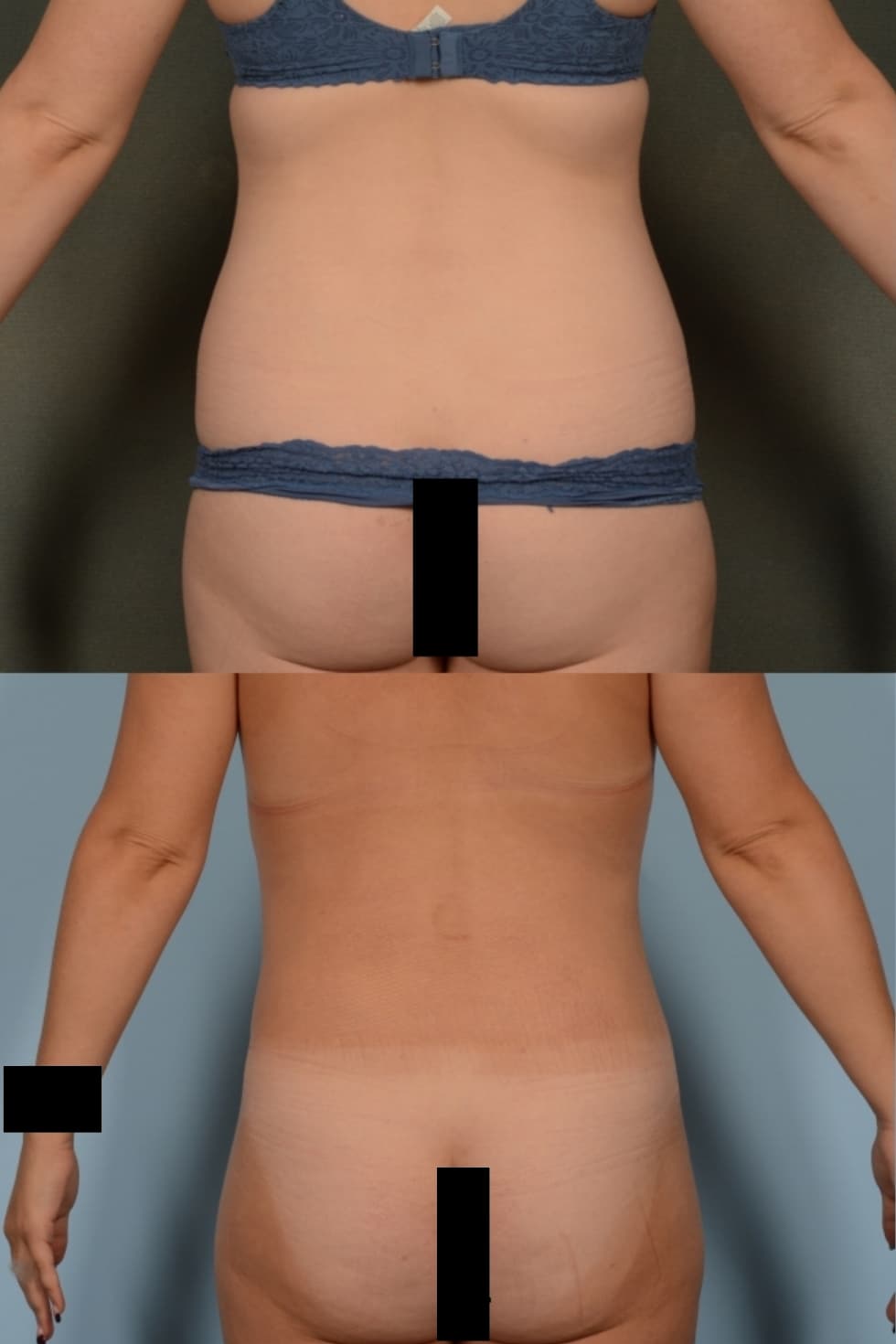 Liposuction Case# 1103 Combined Image