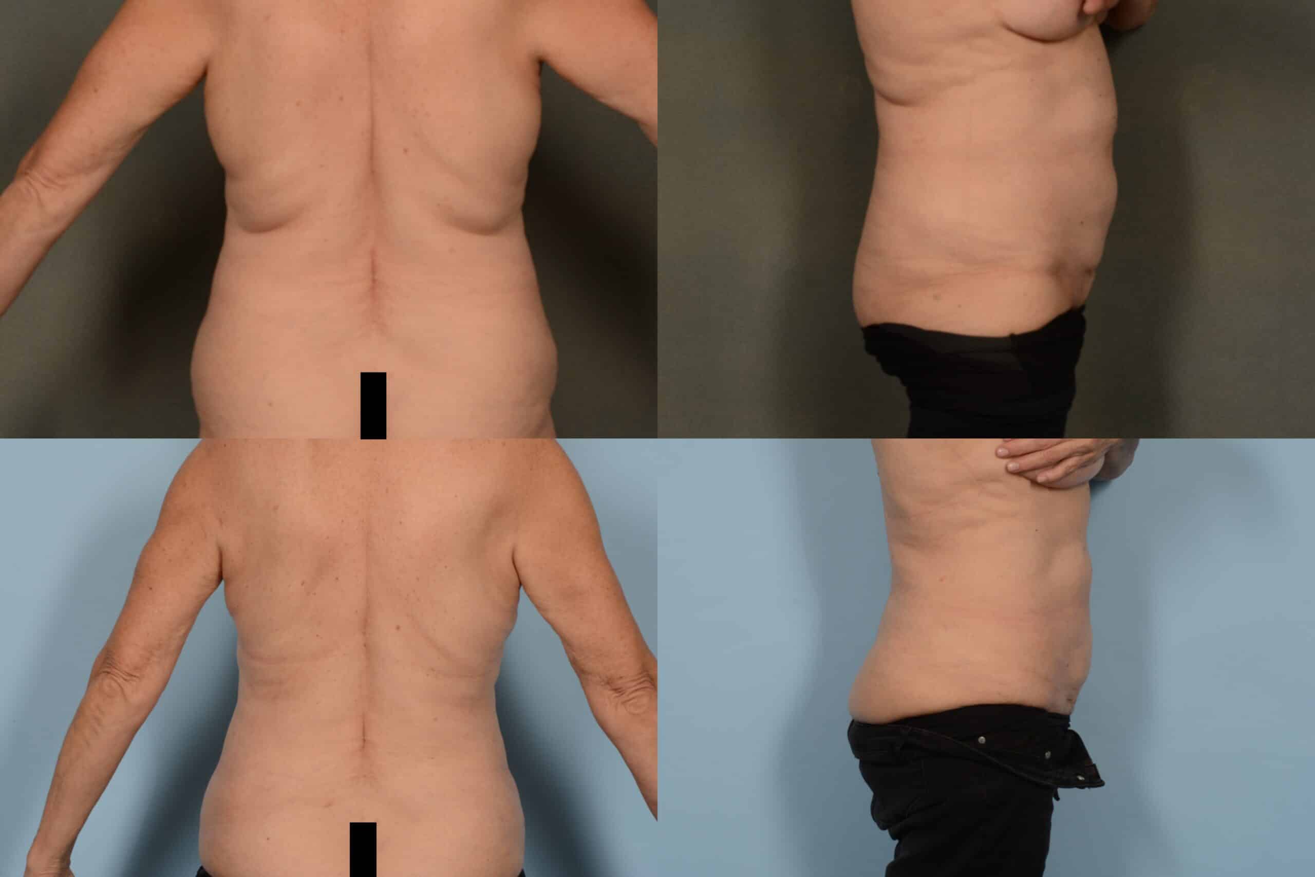 Liposuction Case# 1070 Combined Image