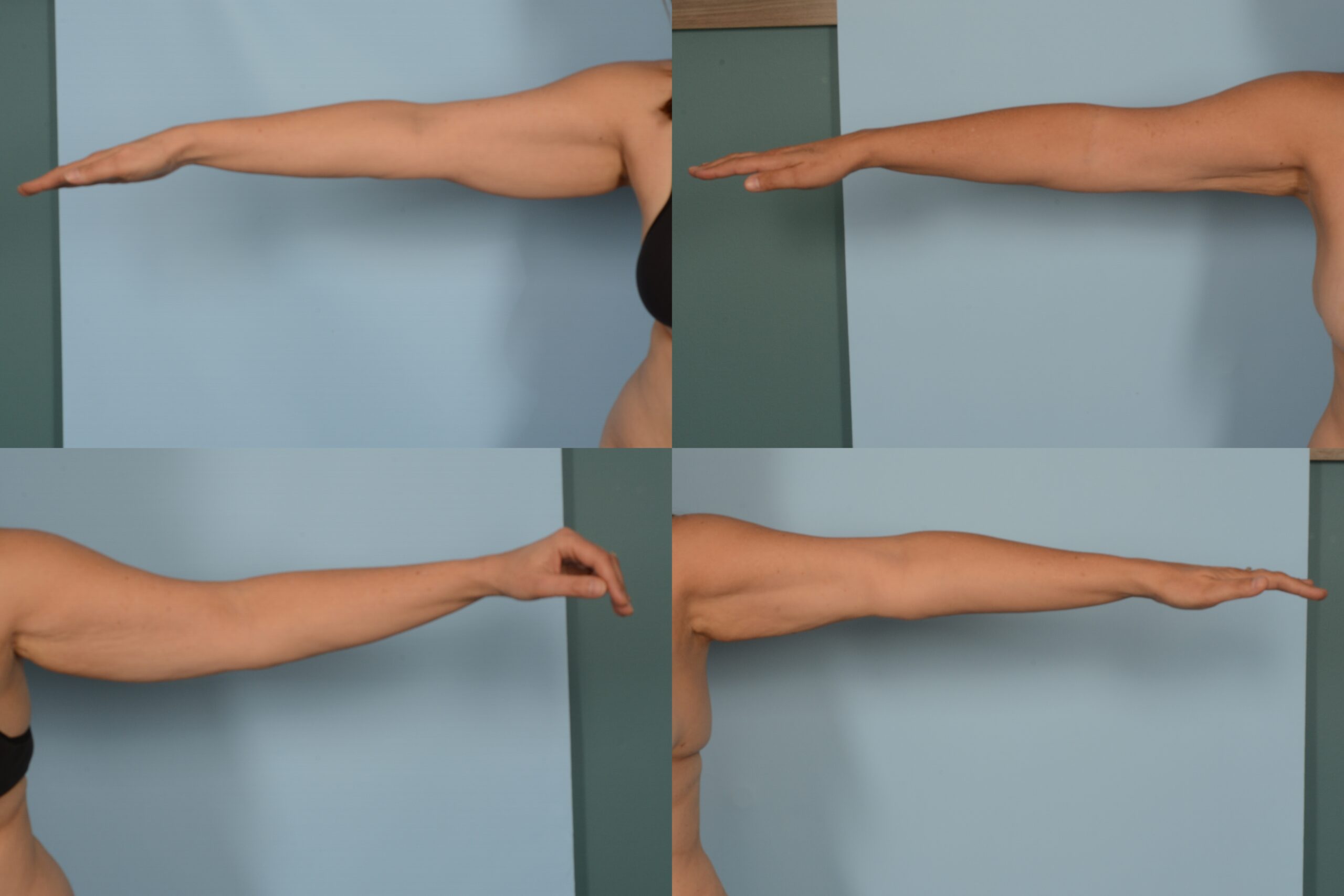 Liposuction Case# 1155 Combined Image