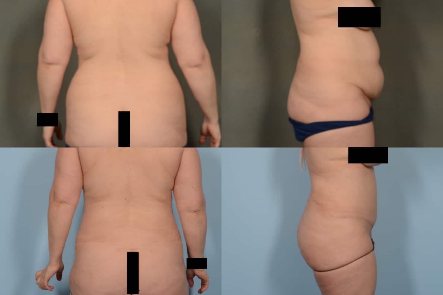 Liposuction Case# 1082 Combined Image