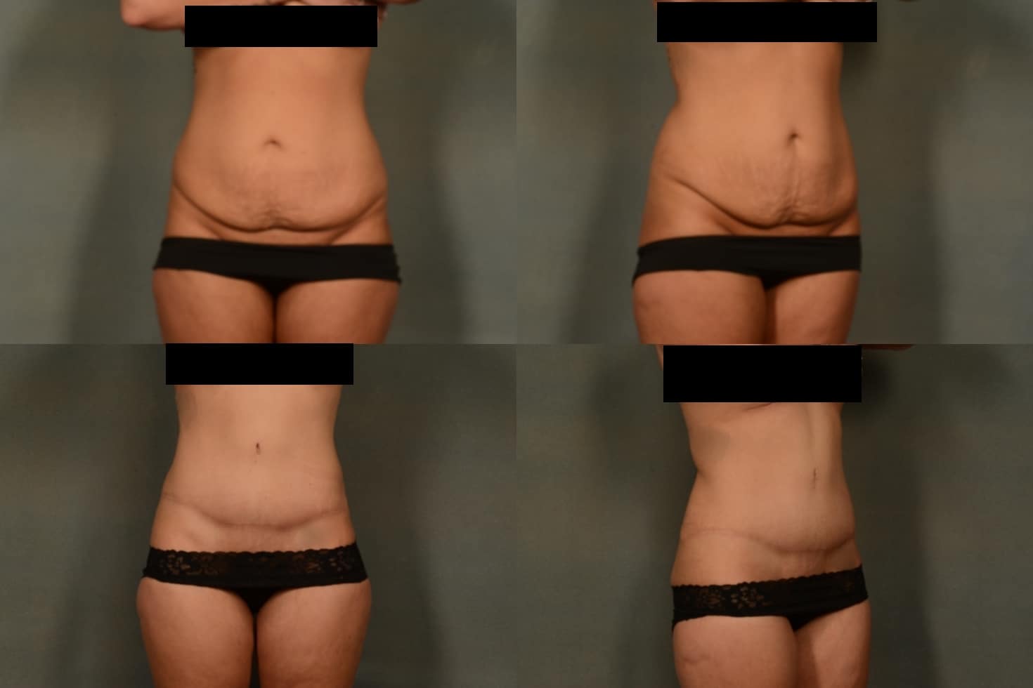 Tummy Tuck Case# 1039 Combined Image