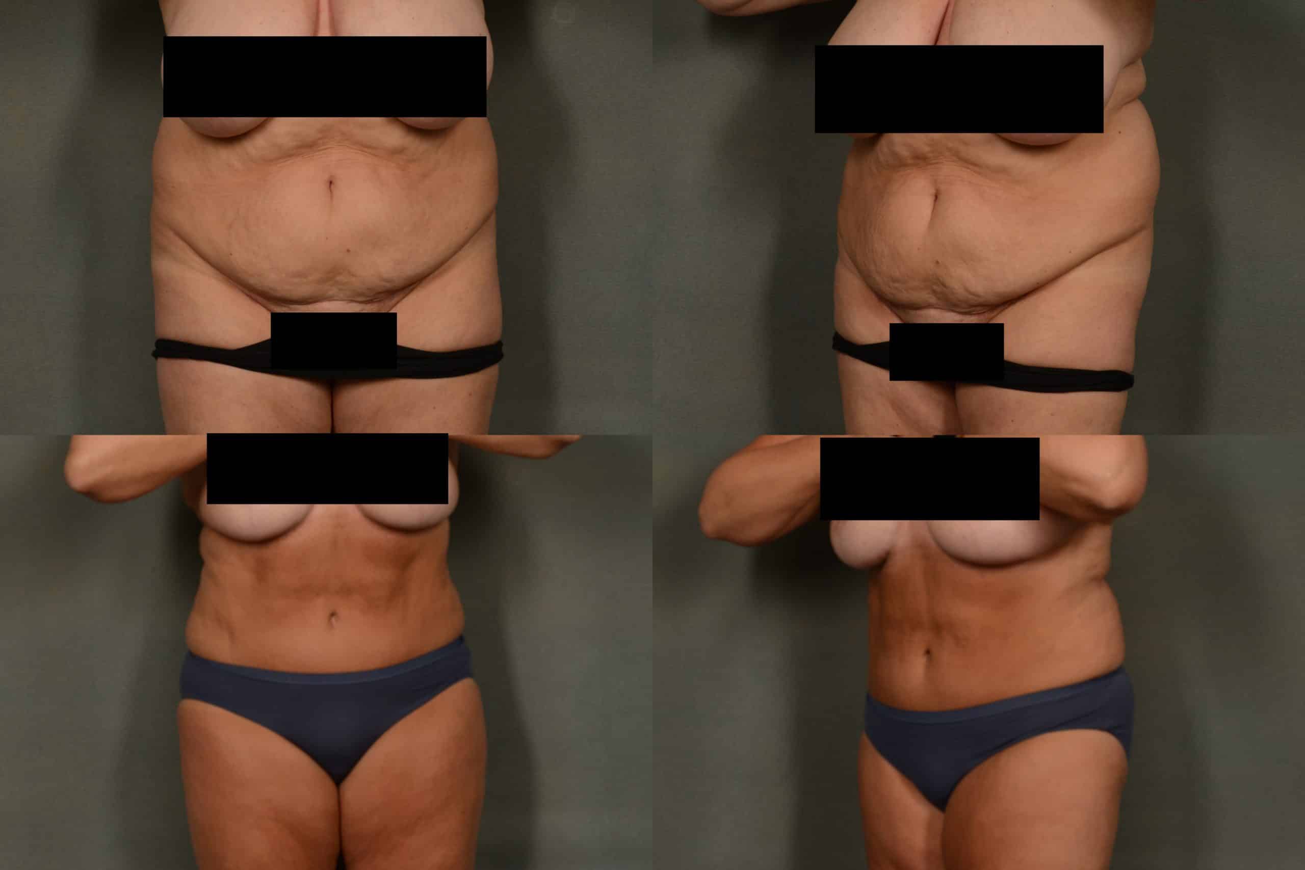 Tummy Tuck Case# 978 Combined Image