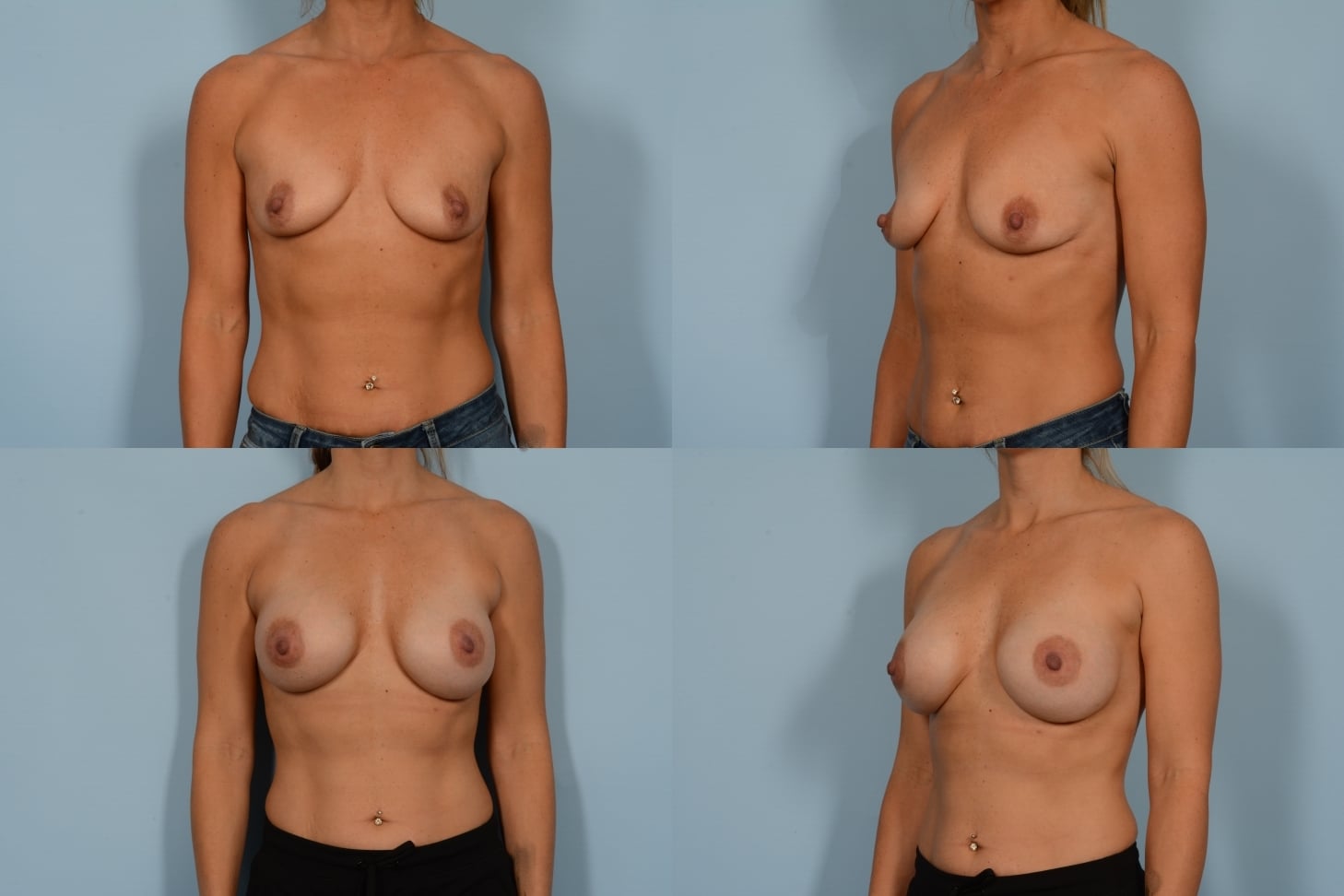 Breast Augmentation 1140 Combined Image