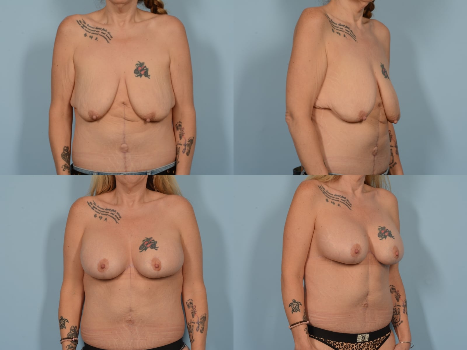 Breast Lift with Augmentation Case# 1200 Combined Image