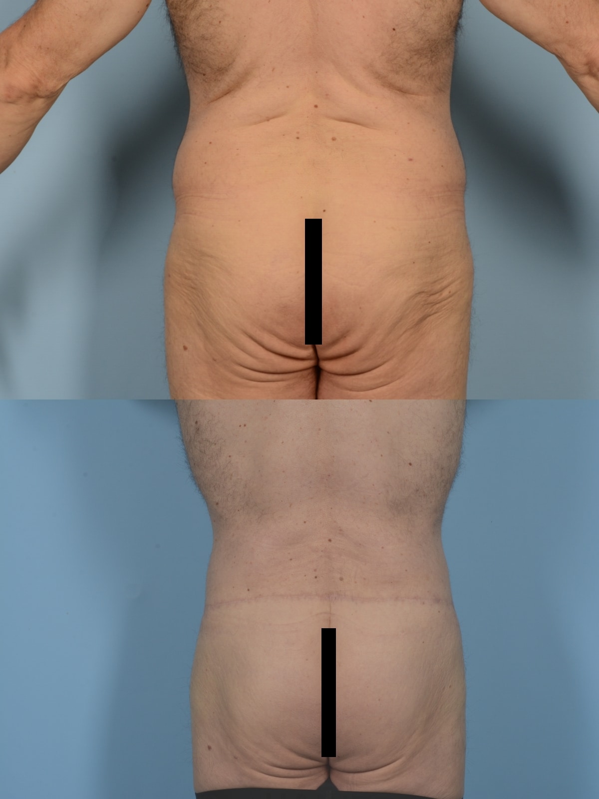Back Lift Case# 1186 Combined Image