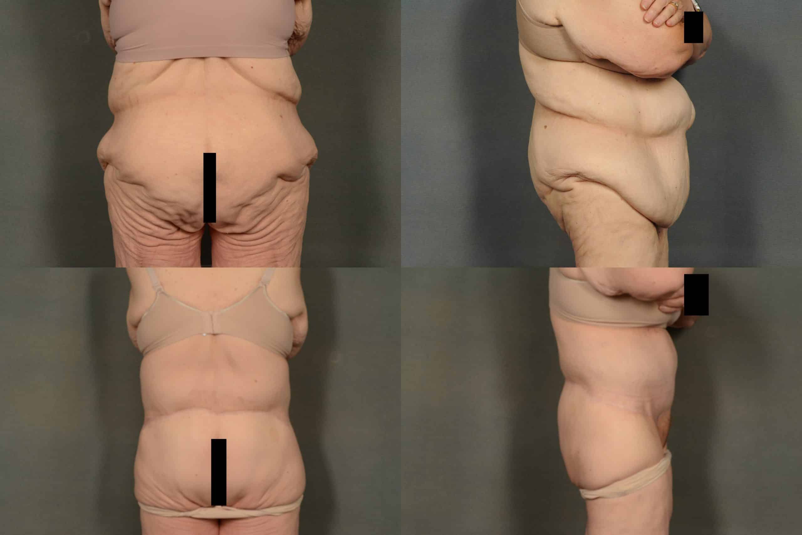 Back Lift Case# 961 Combined Image