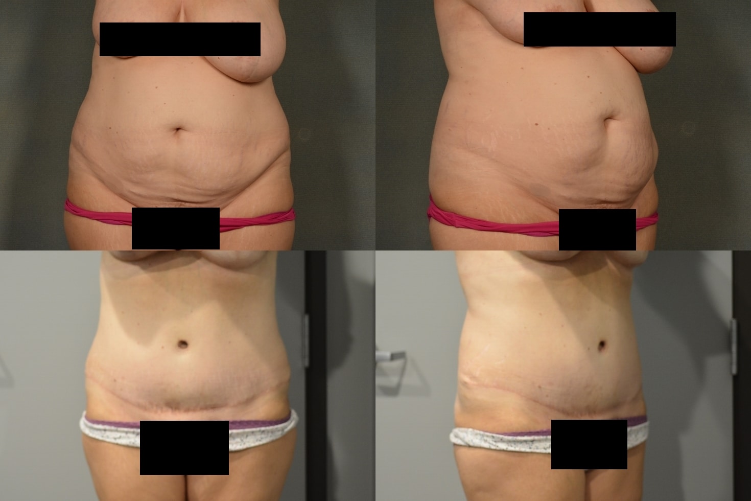 Tummy Tuck Case# 981 Combined Image