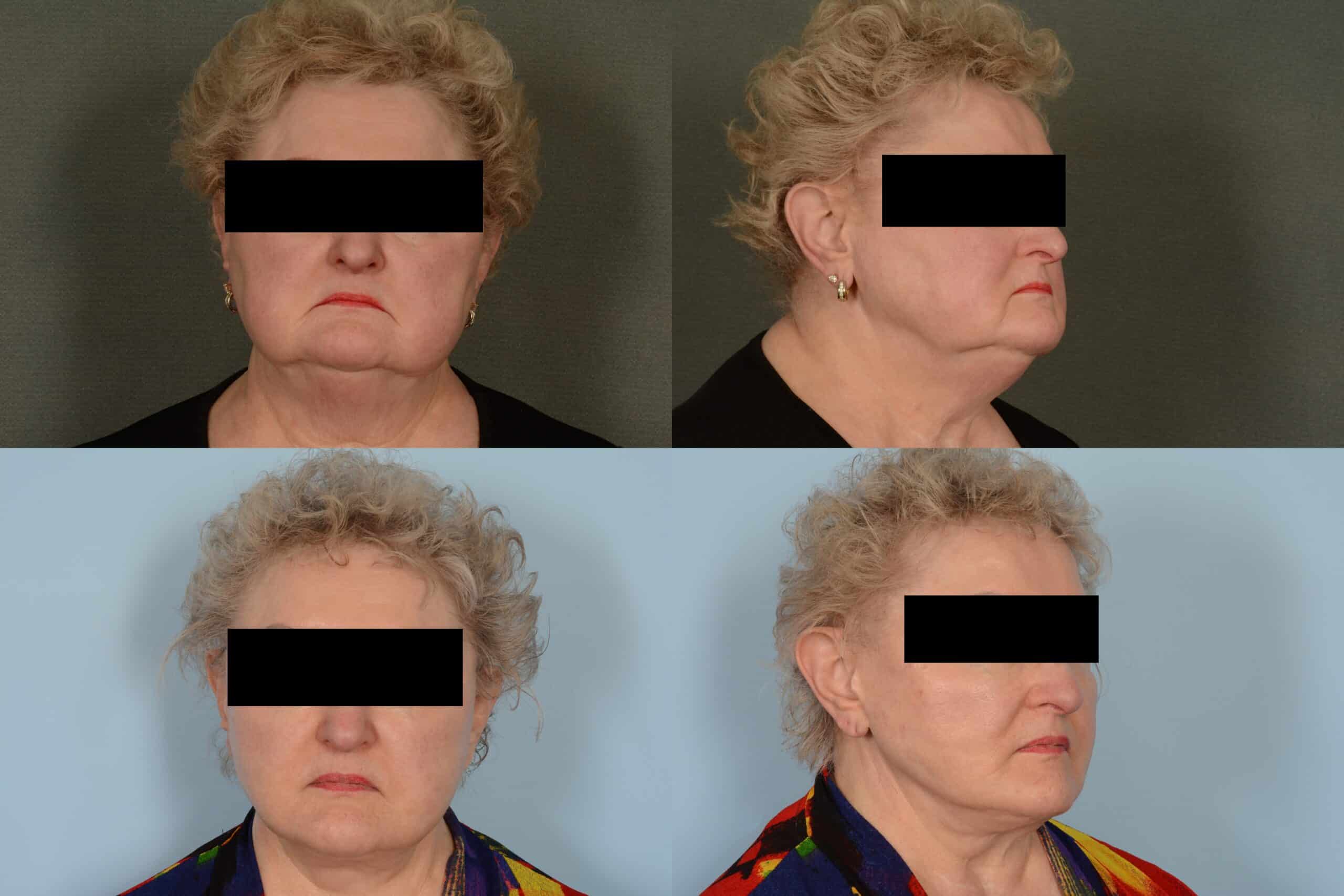 Face Lift Case# 1121 Combined Image