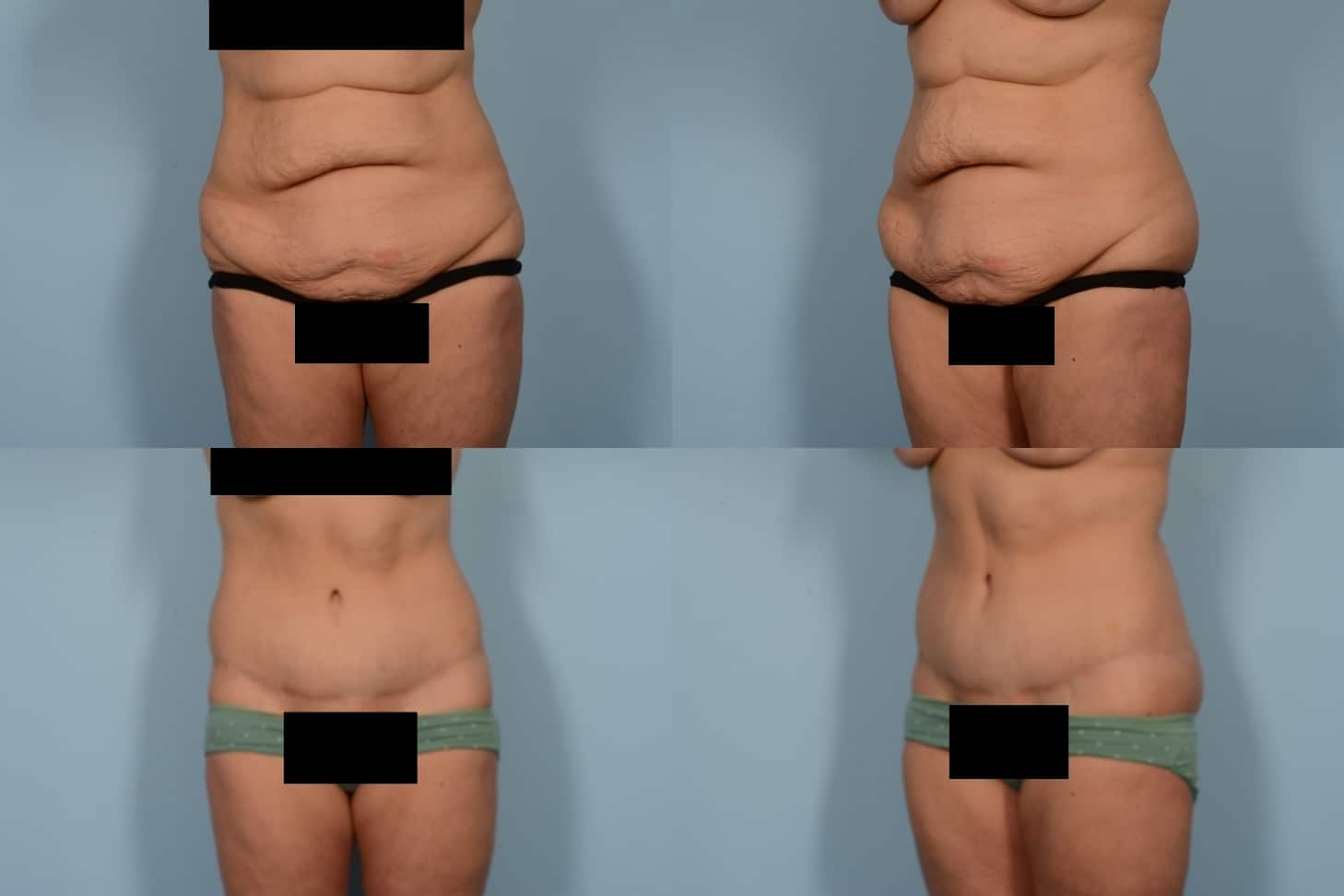 Tummy Tuck Case# 1151 Combined Image