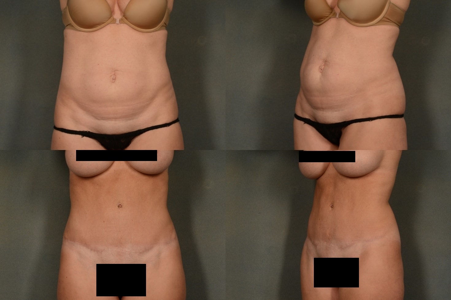 Tummy Tuck Case# 974 Combined Image