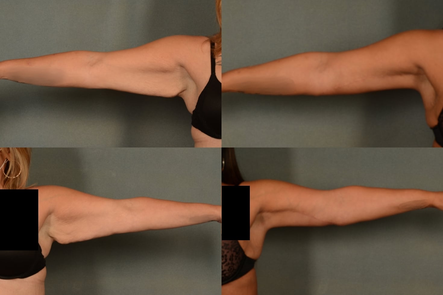 Arm Lift Case# 997 Combined Image