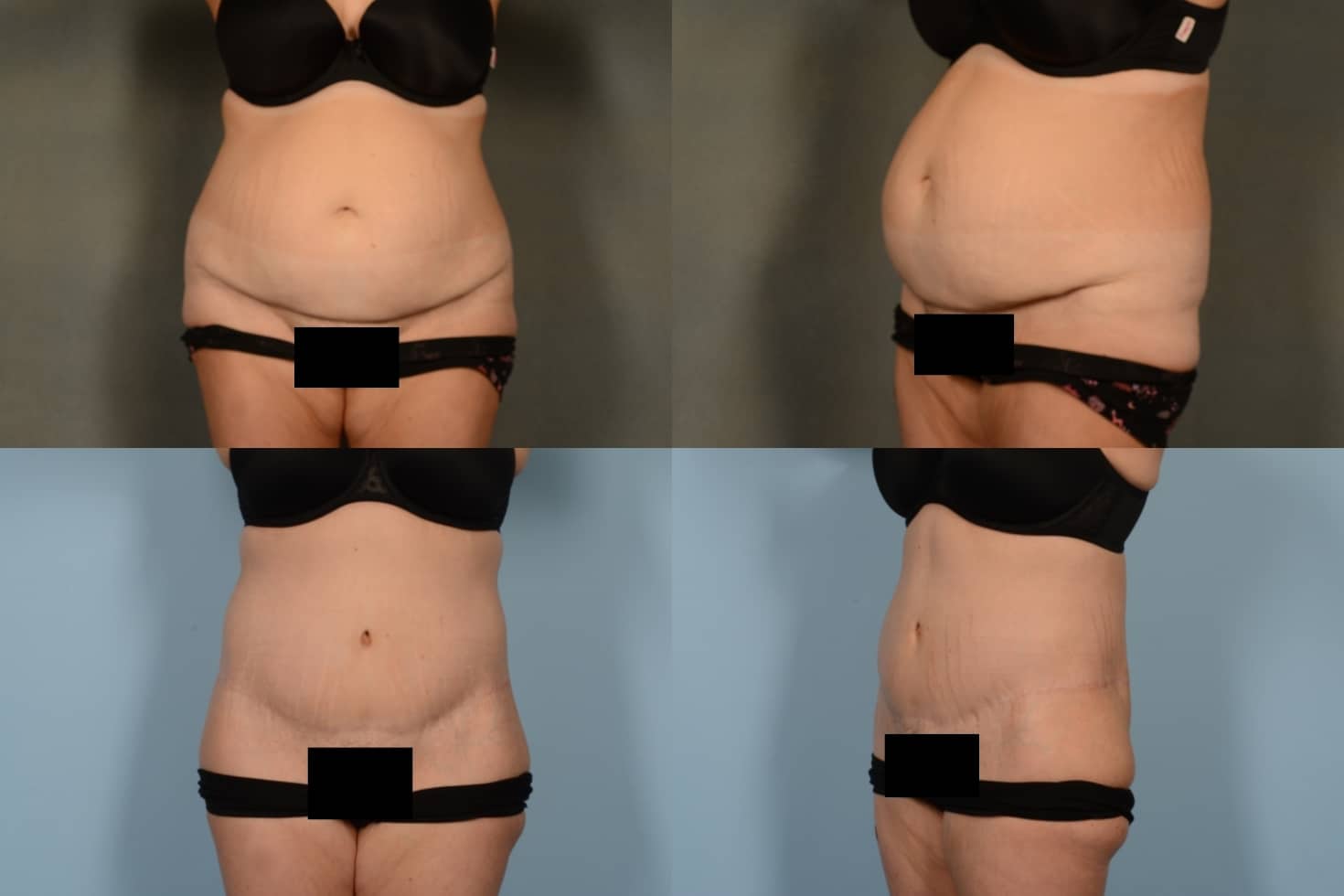 Tummy Tuck Case# 1099 Combined Image