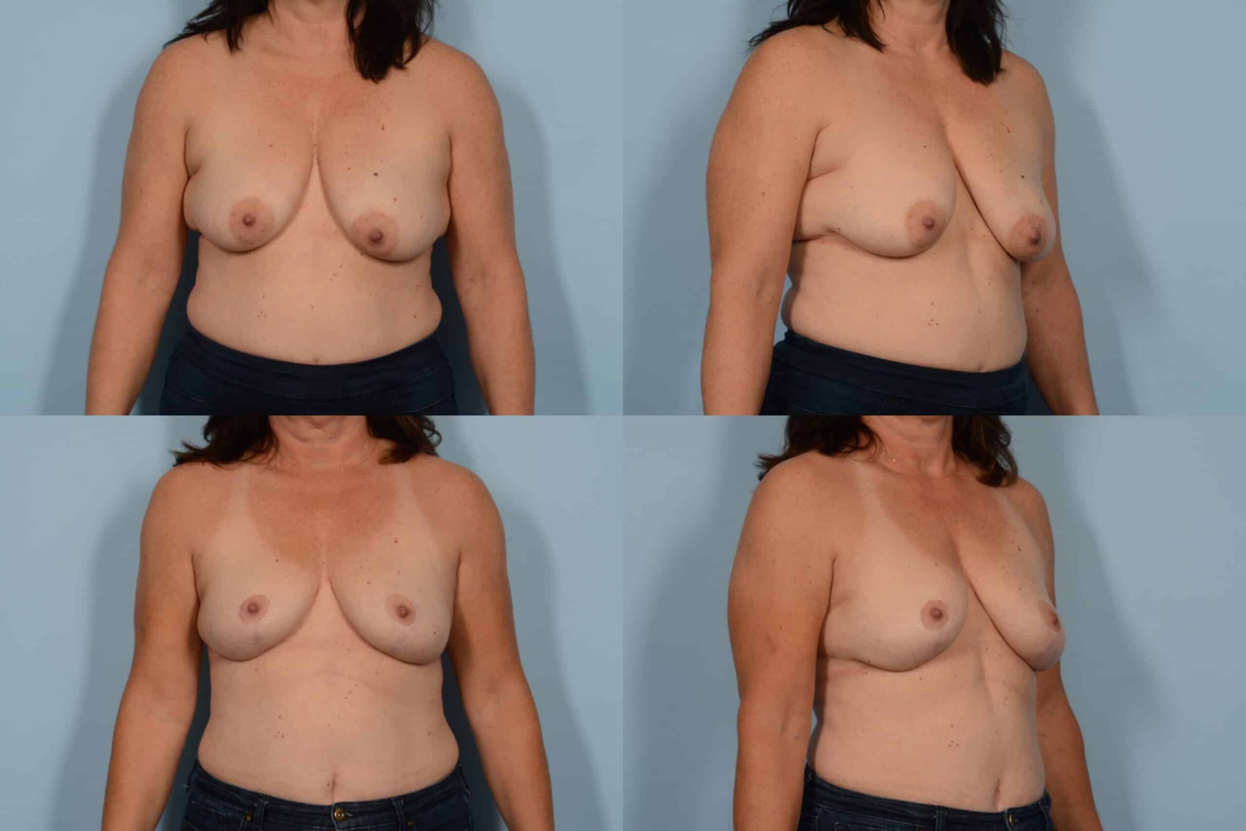 Breast Lift Case# 1114 Combined Image