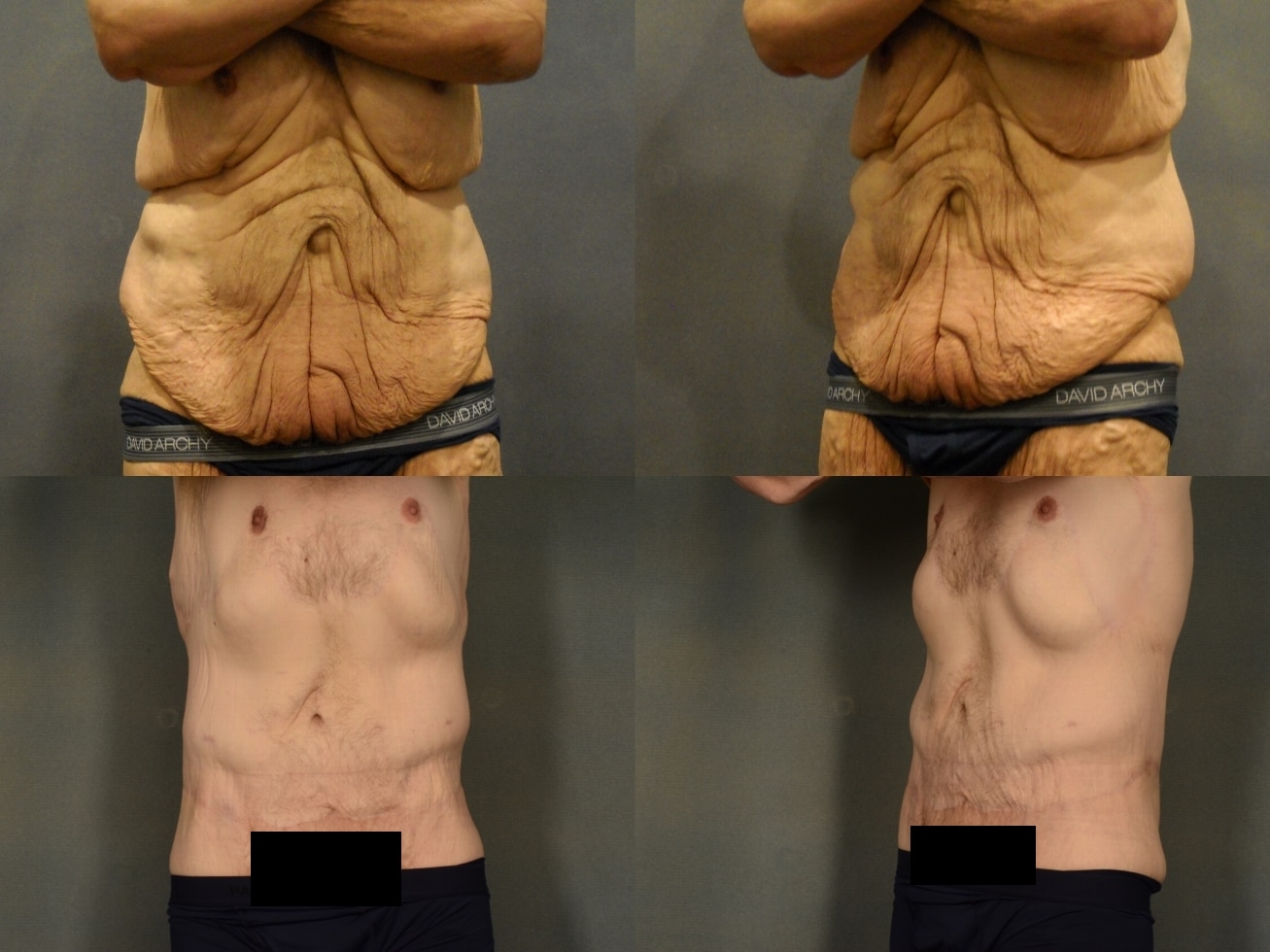 Tummy Tuck Case# 983 Combined Image
