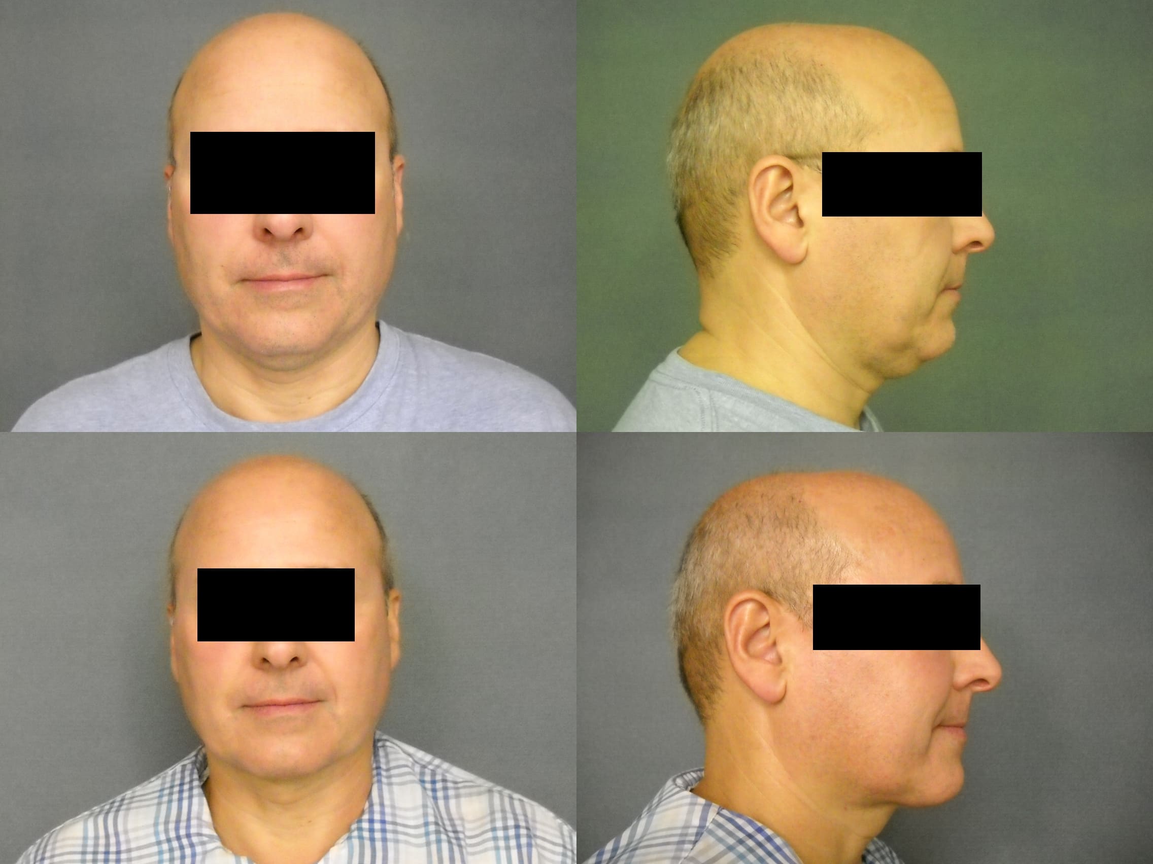 Liposuction Case# 304 Combined Image