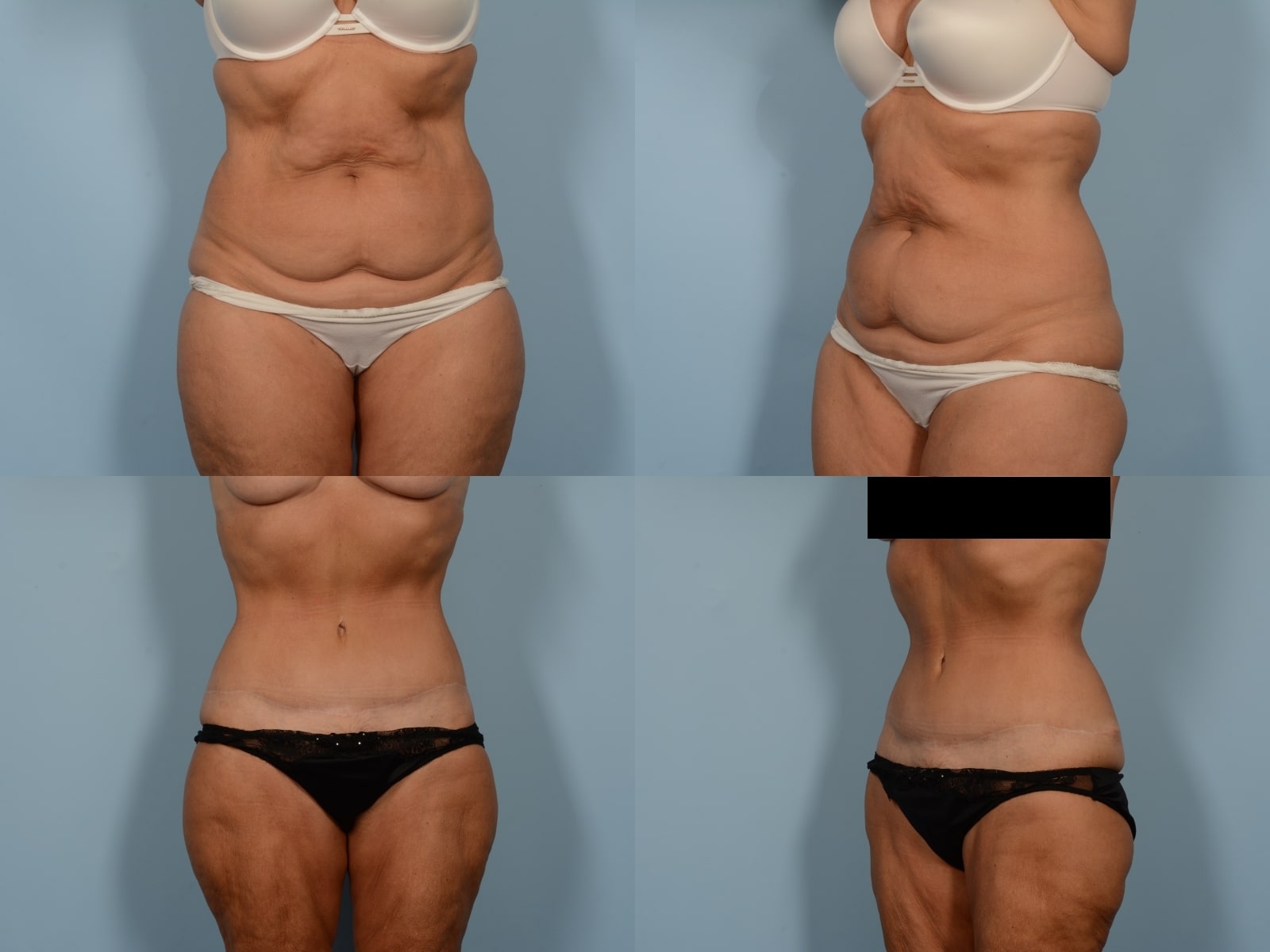 Tummy Tuck Case# 1177 Combined Image