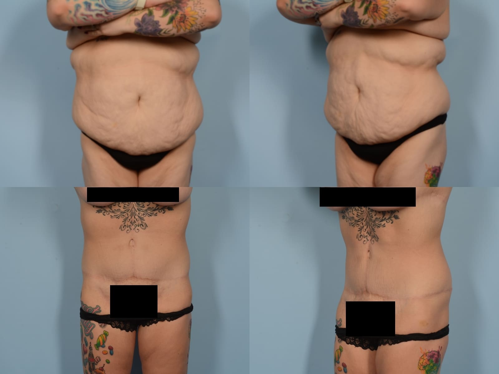 Tummy Tuck Case# 1194 Combined Image
