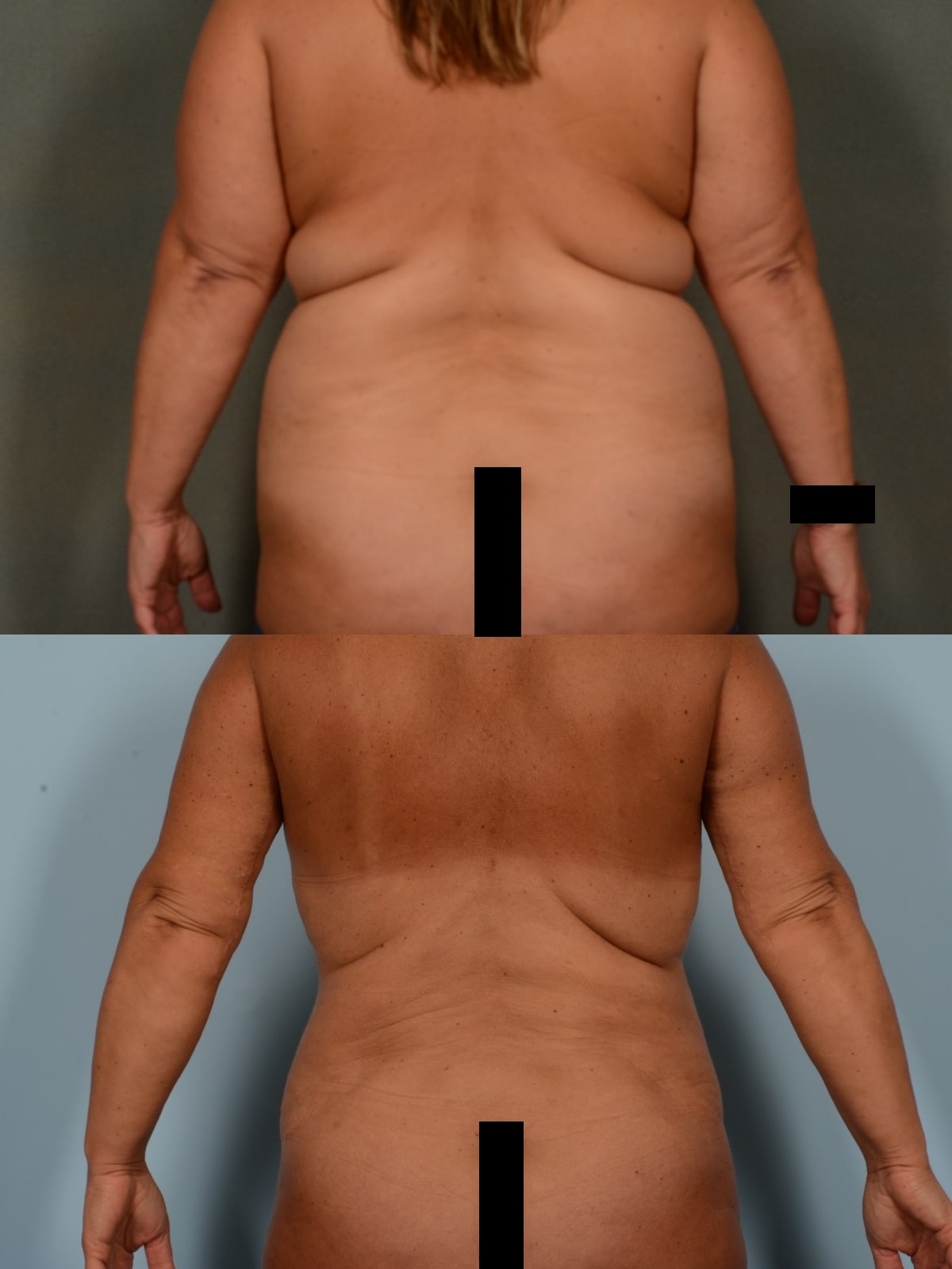 Liposuction Case# 1160 Combined Image