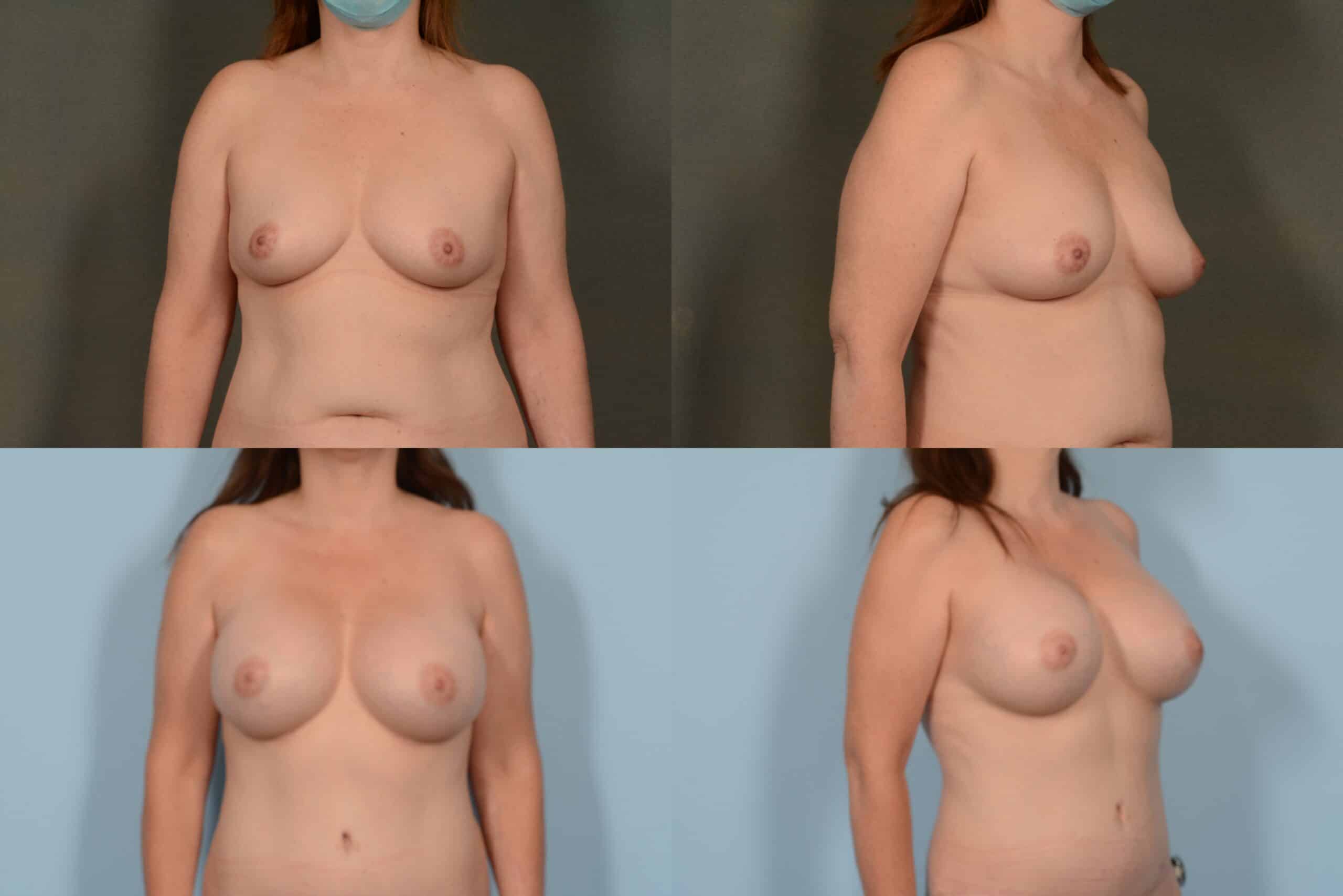 Breast Augmentation Case# 1090 Combined Image